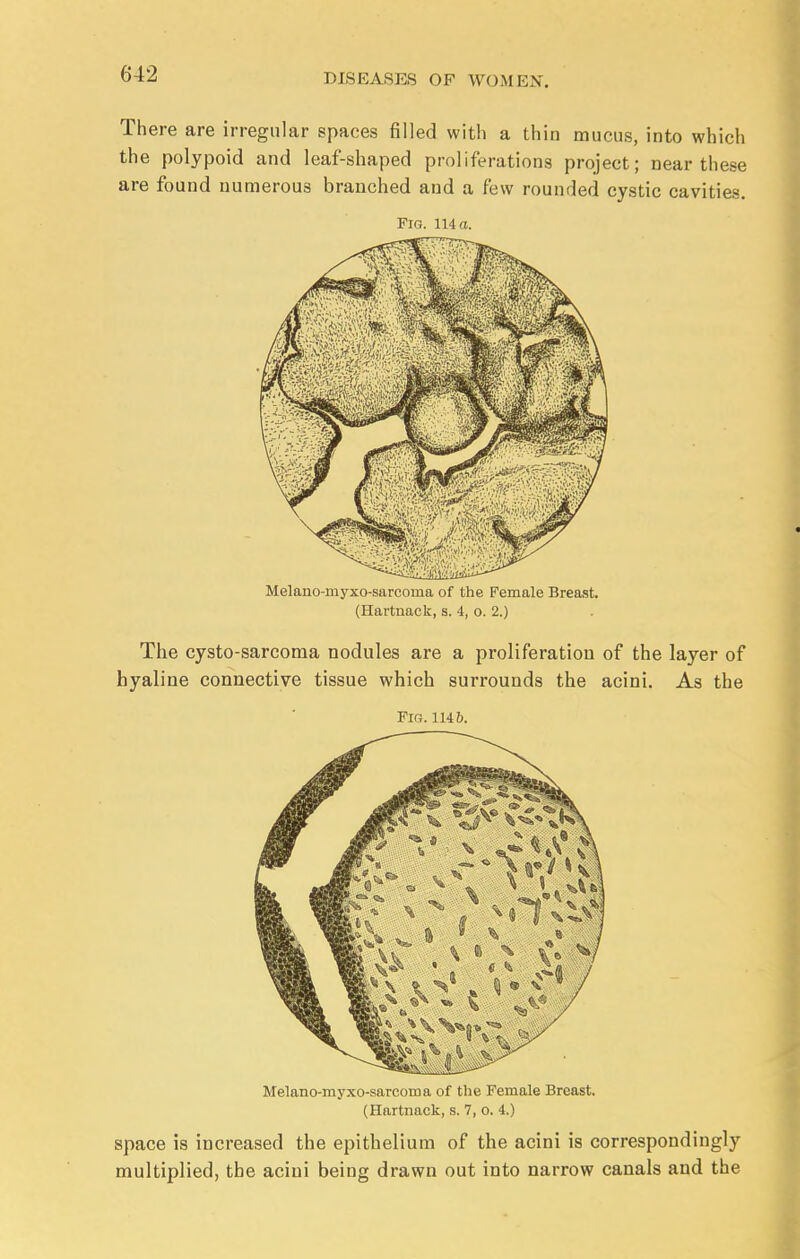 There are irregular spaces filled with a thin mucus, into which the polypoid and leaf-shaped proliferations project; near these are found numerous branched and a few rounded cystic cavities. Fig. 114 a. Melano-myxo-sarcorna of the Female Breast. (Hartnack, s. 4, o. 2.) The cysto-sarcoma nodules are a proliferation of the layer of hyaline connective tissue which surrounds the acini. As the Fig. 1146. Melano-myxo-sarcoma of the Female Breast. (Hartnack, s. 7, o. 4.) space is increased the epithelium of the acini is correspondingly multiplied, the acini being drawn out into narrow canals and the