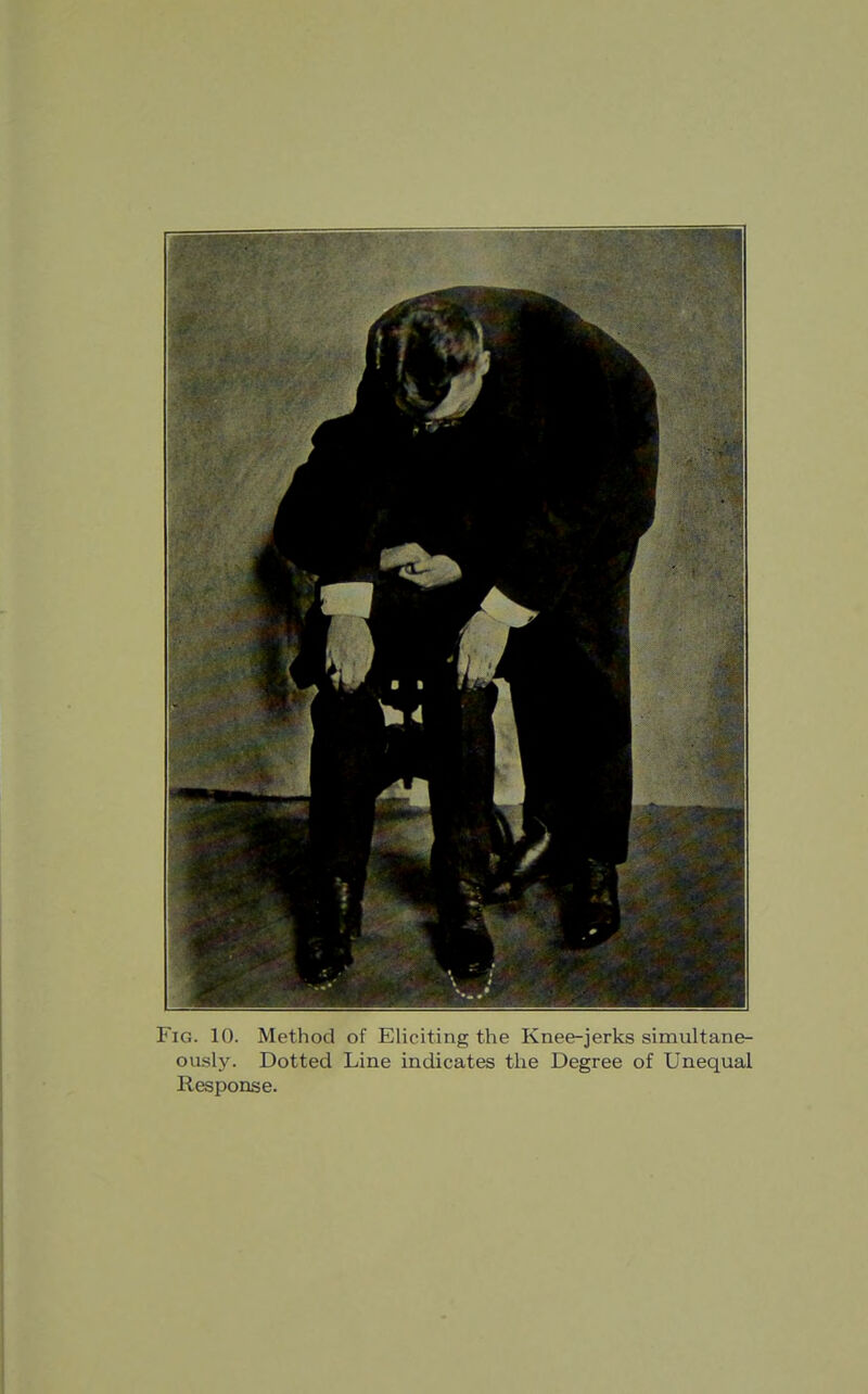 Fig. 10. Method of Eliciting the Knee-jerks simultane- ously. Dotted Line indicates the Degree of Unequal Response.