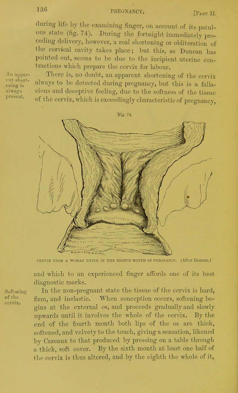 (luring life by the examining finger, on account of its patul- ous^ state (fig. 74). During the fortnight immediately pre- ceding delivery, however, a real shortening or obliteration of the cervical cavity takes place; but this, as Duncan has pointed out, seems to be due to the incipient uterine con- tractions which prepare the cervix for labour. There is, no doubt, an apparent shortening of the cervix always to be detected diuing pregnancy, but this is a falla- cious and deceptive feeling, due to the softness of the tissue of the cervix, which is exceedingly characteristic of pregnancy, Fig. 74. CERVIX rUOM A WOMAN DYING IN THE KIGHTH MONTH OF PREGNANCY. (Aftor Duncan.) and which to an experienced finger affords one of its best diagnostic marks. In the non-pregnant state the tissue of the cervix is hard, firm, and inelastic. When conception occurs, softening be- gins at the external os, and proceeds gradually and slowly upwards until it involves the whole of the cervix. By the end of the fourth month both lips of the os are thick, softened, and velvety to the touch, giving a sensation, likened by Cazeaux to that produced by pressing on a table through a thick, soft cover. By the sixth month at least one half of the cervix is thus altered, and by the eighth the whole of it.