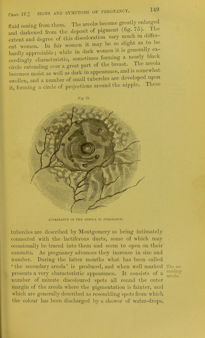 fluid oozing from them. The areolae become greatly enla.-ged and darkened from the deposit of pigment (fig. 75). ihe extent and degree of this discoloration vary much m differ- ent women. In fair women it may be so shght as to be hardly appreciable; while in dark women it is generally ex- ceedingly characteristic, sometimes forming a nearly black circle extending over a great part of the breast. The areola becomes moist as well as dark in appearance, and is somewhat swollen, and a number of small tubercles are developed upon it, forming a circle of projections around the nipple. Ihese F;g. 75. APPEAnA^•CE OP THE AREOLA K riiEQNANCT. tubercles are described by Montgomery as being intimately connected with the lactiferous ducts, some of which may . occasionally be traced into them and seem to open on their summits. As pregnancy advances they increase in size and nmnber. During the latter months what has been called ' the secondary areola' is produced, and when well marked Tlic sa- presents a very characteristic appearance. It consists of a number of minute discoloured spots all round the outer margin of the areola where the pigmentation is fainter, and which are generally described as resembling spots from which the colour has been discharged by a shower of water-drops.