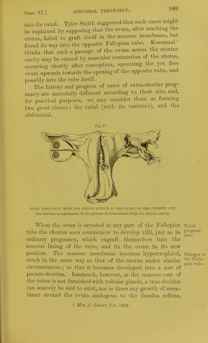 into its canal. Tyler Smith suggested that such cases might be explained by supposing that the ovum, after reaching the uterus, failed to graft itself in the mucous membrane, but found its way into the opposite Fallopian tube. Kussmaul thinks that such a passage of the ovum across theuterme cavity may be caused by muscular contraction of the uterus, occurring shortly after conception, squeezing the yet free ovum upwards towards the opening of the opposite tube, and possibly into the tube itself. The history and progress of cases of extra-uterine preg- nancy are materially different according to their site, and, for practical purposes, we may consider them as forming two great classes : the tubal (with its varieties), and the abdominal. When the ovum is arrested in any part of the Fallopian Tubal tube the chorion soon commences to develop villi, iust as in preg<i- ordinary pregnancy, which engraft themselves into the mucous lining of the tube, and j&x the ovum in its new position. The mucous membrane becomes hypertrophied, Changes much in the same way as that of the uterus under similar -'^'^l'' pian tub circumstances; so that it becomes developed into a sort of pseudo-decidua. Inasmuch, however, as the mucous coat of the tubes is not furnished with tubular glands, a true decidua can scarcely be said to exist, nor is there any growth of mem- brane around the ovum analogous to the decidua reflexa. ' Mon.f. Geburt, Oct. 1862.