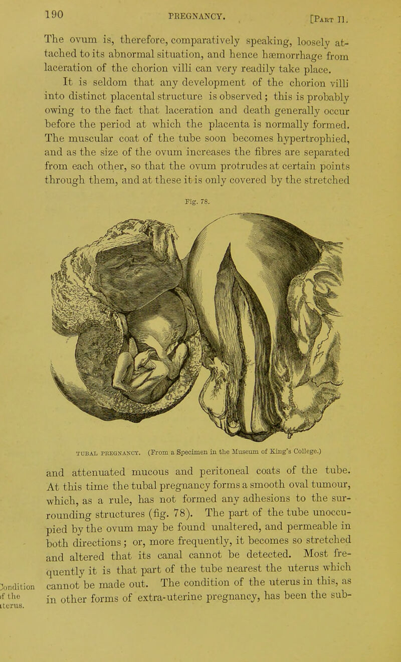[Part II. The ovum is, therefore, comparatively speaking, loosely at- tached to its abnormal situation, and hence haemorrhage from laceration of the chorion villi can very readily take place. It is seldom that any development of the chorion villi into distinct placental structm-e is observed; this is probably owing to the fact that laceration and death generally occur before the period at which the placenta is normally formed. The muscular coat of the tube soon becomes hypertrophied, and as the size of the ovum increases the fibres are separated from each other, so that the ovum protrudes at certain points through them, and at these it is only covered by the stretched Fig. 78. TUBAL PIVEGNASOT. (From a Specimen in the Museum of Kiug's College.) and attenuated mucous and peritoneal coats of the tube. At this time the tubal pregnancy forms a smooth oval tumour, which, as a rule, has not formed any adhesions to the sur- rounding structures (fig. 78). The part of the tube unoccu- pied by the ovum may be found unaltered, and permeable in both directions; or, more frequently, it becomes so stretched and altered that its canal cannot be detected. Most fre- quently it is that part of the tube nearest the uterus which Condition cannot be made out. The condition of the uterus in this, as ^'^^ in other forms of extra-uterine pregnancy, has been the sub- iturus.