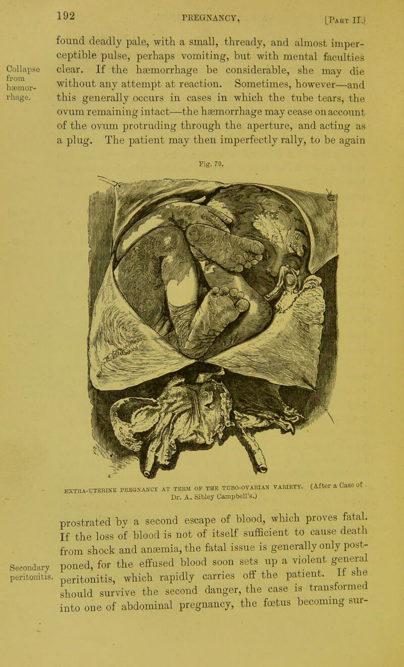 found deadly pale, with a small, thready, and almost imper- ceptible pulse, perhaps vomiting, but with mental faculties clear. If the htemorrhage be considerable, she may die without any attempt at reaction. Sometimes, however—and this generally occurs in cases in which the tube tears, the ovum remaining intact—the haemorrhage may cease on account of the ovum protruding through the aperture, and acting as a plug. The patient may then imperfectly rally, to be again Fig. 79, EXTRA-UTERINE PREGSA2fCY AT TERM OP TETE TUBO-OVARIAS VAMETY. (After a CaSe o£ Dr. A. Sibley CampbeU's.) prostrated by a second escape of blood, which proves fatal. If the loss of blood is not of itself sufficient to cause death from shock and antemia, the fatal issue is generally only post- SeeoncW poned, for the effused blood soon sets up a violent general peritonitis, peritonitis, which rapidly carries off the patient, it sne should survive the second danger, the case is transformed into one of abdominal pregnancy, the foetus becommg sur-