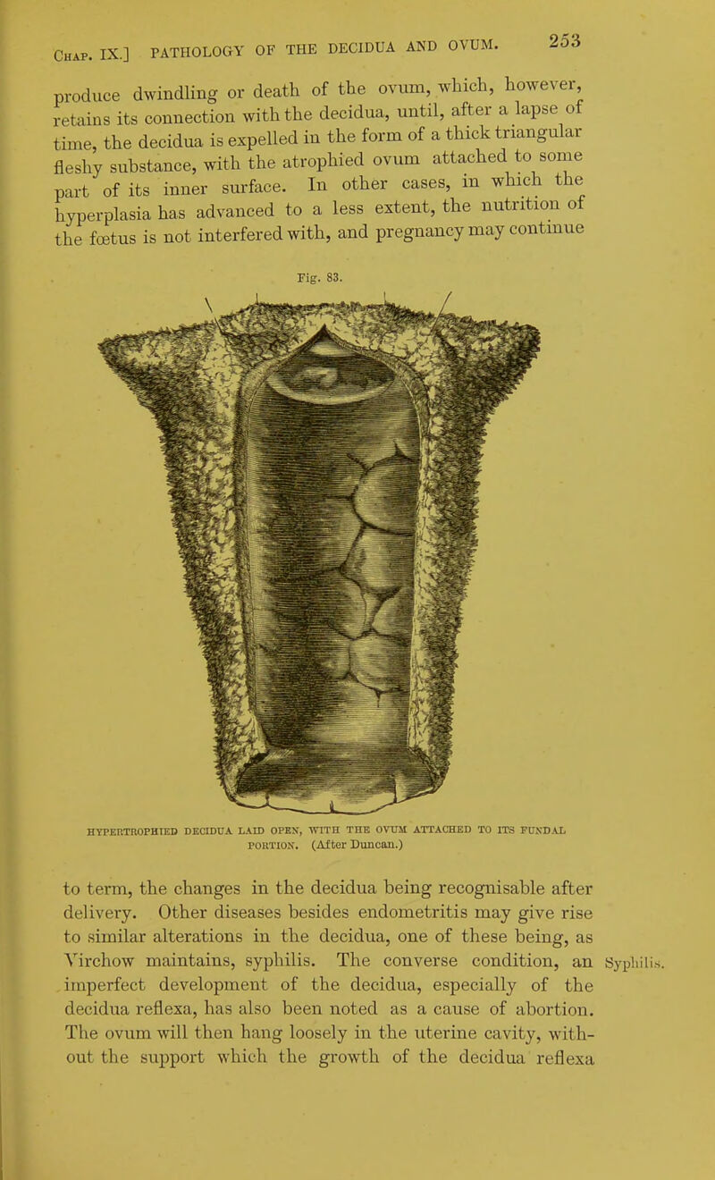 Chap. IX.] PATHOLOGY OF THE DECIDUA AND OVUM. produce dwindling or death of the ovum, which, however retains its connection with the decidua, until, after a lapse of time, the decidua is expelled in the form of a thick triangular fleshy substance, with the atrophied ovum attached to some part of its inner surface. In other cases, in which the hyperplasia has advanced to a less extent, the nutrition of the foetus is not interfered with, and pregnancy may continue Fig. 83. HTPEIlTnOPHIED DKCIDUA L.\ID OPEN, WITH THE OVUM ATTACHED TO ITS PUNDXL POiiTiON. (After Duncan.) to term, the changes in the decidua being recognisable after delivery. Other diseases besides endometritis may give rise to .similar alterations in the decidua, one of these being, as Virchow maintains, syphilis. The converse condition, an Sypli imperfect development of the decidua, especially of the decidua reflexa, has also been noted as a cause of abortion. The ovum will then hang loosely in the uterine cavity, with- out the support which the growth of the decidua reflexa