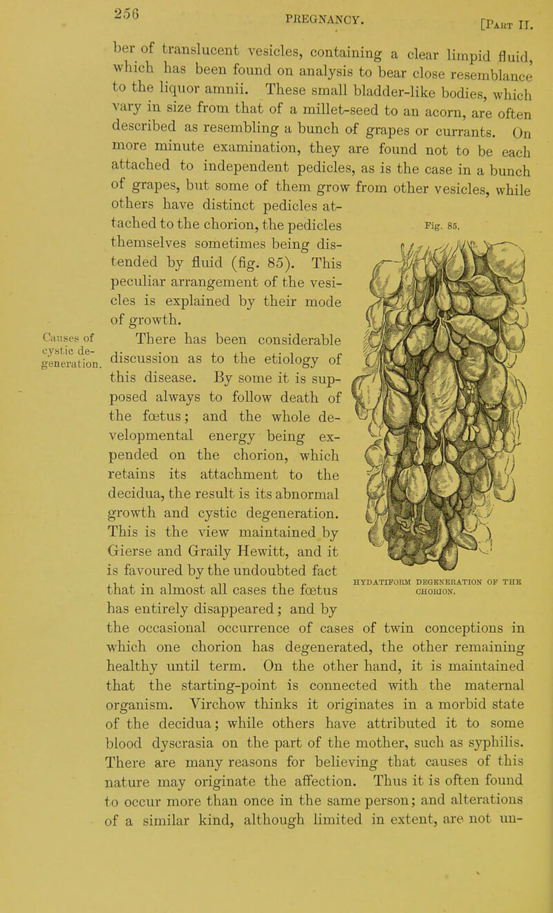 PREGNANCY. Fig. 85. Ciinses of cystic de- generation. [Paut ir, ber of translucent vesicles, containing a clear limpid fluid, which has been found on analysis to bear close resemblance to the liquor amnii. These small bladder-like bodies, which vary in size from that of a millet-seed to an acorn, are often described as resembling a bunch of grapes or currants. On more minute examination, they are found not to be each attached to independent pedicles, as is the case in a bunch of grapes, but some of them grow from other vesicles, while others have distinct pedicles at- tached to the chorion, the pedicles themselves sometimes being dis- tended by flmd (fig. 85). This peculiar arrangement of the vesi- cles is explained by their mode of growth. There has been considerable discussion as to the etiology of this disease. By some it is sup- posed always to follow death of the foetus; and the whole de- velopmental energy being ex- pended on the chorion, which retains its attachment to the decidua, the result is its abnormal growth and cystic degeneration. This is the view maintained by Gierse and Grraily Hewitt, and it is favoured by the undoubted fact that in almost all cases the foetus has entirely disappeared; and by the occasional occurrence of cases of twin conceptions in which one chorion has degenerated, the other remaining healthy until term. On the other hand, it is maintained that the starting-point is connected with the maternal organism. Virchow thinks it originates in a morbid state of the decidua; while others have attributed it to some blood dyscrasia on the part of the mother, such as syphilis. There are many reasons for believing that causes of this nature may originate the affection. Thus it is often found to occur more than once in the same person; and alterations of a similar kind, although limited in extent, are not un- HVDATIPOIUI DEGENERATION OP THE CHOIUON.