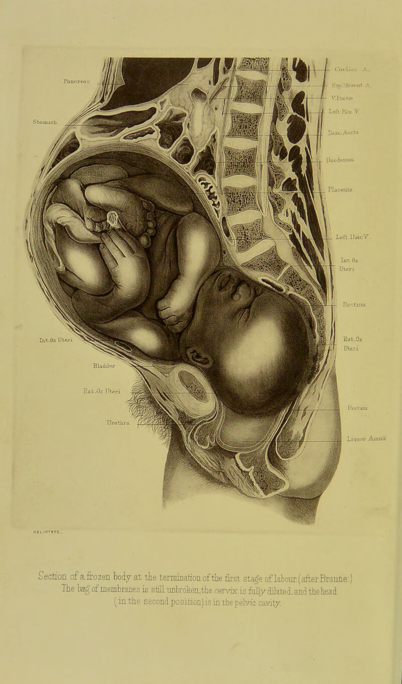 Section of a frozen body at the termination of the first stage of labour.)'after Braune:) The bag of membranes is still unbroliea,the rervbc is fully dilated, and the head (in the second position) is in the pelvic cavity: