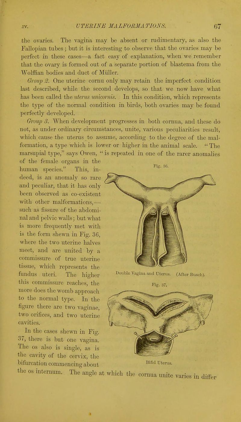 the ovaries. The vagina may be absent or rudimentary, as also the Fallopian tubes; but it is interesting to observe that the ovaries may be perfect in these cases—a fact easy of explanation, when we remember that the ovary is formed out of a separate portion of blastema from the Wolffian bodies and duct of Midler. Gh'oup 2. One uterine cornu only may retain the imperfect condition last described, while the second develops, so that we now have what has been called the uterus unicornis. In this condition, which represents the type of the normal condition in birds, both ovaries may be found perfectly developed. Group 3. When development progresses in both cornua, and these do not, as under ordinary circumstances, unite, various peculiarities result, which cause the uterus to assume, according to the degree of the mal- formation, a type which is lower or higher in the animal scale.  The marsupial type, says Owen,  is repeated in one of the rarer anomalies of the female organs in the human species. This, in- deed, is an anomaly so rare and peculiar, that it has only been observed as co-existent with other malformations,— such as fissure of the abdomi- nal and pelvic walls; but what is more frequently met with is the form shewn in Fig. 36, where the two uterine halves meet, and are united by a commissure of true uterine tissue, which represents the fundus uteri. The higher this commissure reaches, the more does the womb approach to the normal type. In the figure there are two vaginae, two orifices, and two uterine cavities. In the cases shewn in Fig. 37, there is but one vagina. The os also is single, as is the cavity of the cervix, the bifurcation commencing about Double Vagina and Uterus. Fig. 37. (After Busch), Bifid Uterus. the os internum. The angle at which the cornua unite varies in differ ft