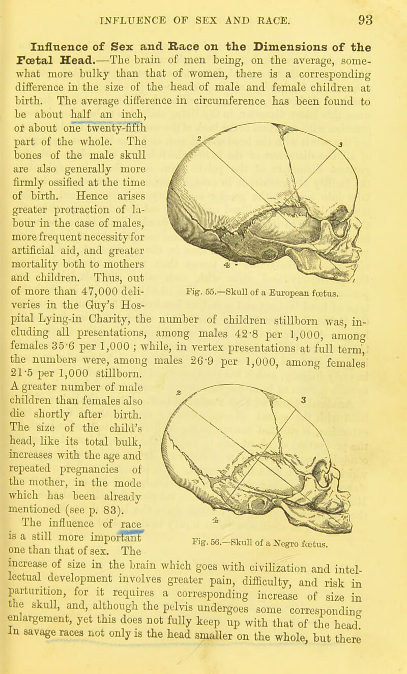 Pig. 55.—Skull of a Etiropean foetus. Influence of Sex and Bace on tlie Dimensions of the Foetal Head.—The brain of men being, on the average, some- what more bulky than that of women, there is a corresponding difference in the size of the head of male and female children at birth. The average difference in circumference has been found to be about half an inch, or aboiit one twenty-fifth part of the whole. The bones of the male skull are also generally more firmly ossified at the time of birth. Hence arises greater protraction of la- bour in the case of males, more frequent necessity for artificial aid, and greater mortality both to mothers and children. Thus, out of more than 47,000 deli- veries in the Guy's Hos- pital Lying-in Charity, the number of children stillborn was, in- cluding all laresentations, among males 42-8 per 1,000, among females 35'6 per 1,000 ; while, in vertex presentations at full term', the numbers were, among males 26-9 per 1,000, among females 21-5 i)er 1,000 stillborn. A greater number of male children than females also die shortly after birth. The size of the child's head, like its total bulk, increases with the age and repeated pregnancies of the mother, in the mode which has been already mentioned (see p. 83). The influence of race is a still more important one than that of sex. The increase of size in the brain which goes with civiKzation and intel- lectual development involves greater pain, difficulty, and risk in parturition, for it requires a corresponding increase of size in the skuU, and, although the pelvis undergoes some corresponding enlargement, yet this does not fully keep up with that of the head In savage races not only is the head smaller on the whole, but there rig. 56.—Skull of a Negro foetus.