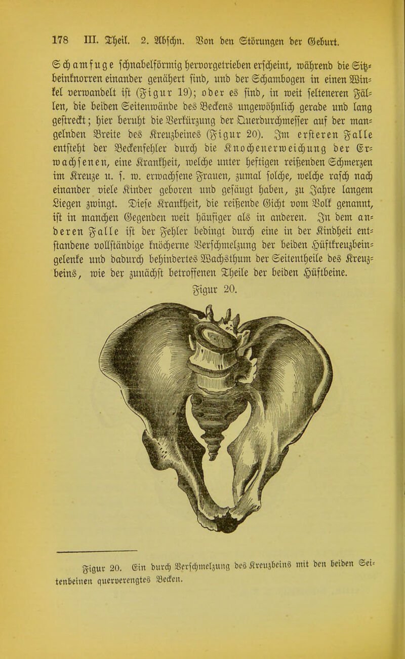 ©amfuge fii^nabelförtiiig fierDorgetrieben erfc^eint, TOätirenb bic ©t^* beinfnorren einanber genät)ert fitib, unb ber ©d;aTnbogen in einen SC3in= fei üerraanbelt ift @igur 19); ober e§ finb, in roeit felteneren göl; len, bie beiben ©eitenmönbe be§ 93e(Jen§ nngeroöfinlic^ gerabe nnb lang ge[tre(ft; I)ier berut)t bie S^erfürsung ber Ouerbnrd^meffer auf ber mav.- gctnben SSreite be§ Kreuzbeines (^^igur 20). erfteren %alU entftel)t ber S3e(JenfeI)Ier burd; bie i^no(^enern)eid;ung ber (Bx- raadE) jenen, eine Kranfljeit, lüelc^e unter heftigen rei^enben Sdimer^en im Brenge u. f. ro. erraodifene grauen, §umal foId)e, roeldie rafd^ nad^ einanber vkle tinber geboren unb gefäugt Jiaben, gu Qatire langem Siegen gmingt. SDiefe Iranffieit, bie reifeenbe @id;t üom 33o[f genannt, ift in mand;en ©egenben meit Ijäufiger al§> in anberen. ^n bem an^ beren ^^alle ift ber ^^etiler bebingt burdi eine in ber Kinb^eit ent= ftanbene rottftänbige fitödierne S^erfc^melgung ber beiben ^üftfreugbein= gelenfe unb baburd; be^inberteS 2ßa(|gtbum ber ©eitenttieile beg Kreuj= beinS, roie ber suuäii^ft betroffenen ber beiben Hüftbeine. gigur 20. gigur 20. ein buvcf) ajcrjcl;metäuii(i beö Äreujljcinö mit ben Beiben tenbeinen queruevengteö Setfcn.