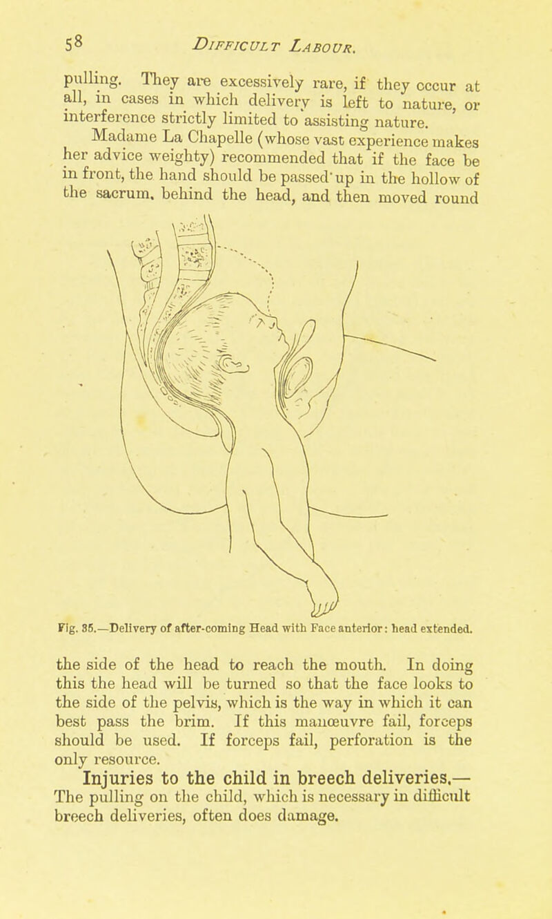 pullmg. ITiey are excessively rare, if they occur at all, m cases in which delivery is left to nature, or interference strictly limited to assisting nature. Madame La Chapelle (whose vast experience makes her advice weighty) recommended that if the face be in front, the hand should be passed'up \x\ the hollow of the sacrum, behind the head, and then moved round Fig. 35.—Delivery of after-coming Head with Face anterior: head extended. the side of the head to reach the mouth. In doing this the head will be turned so that the face looks to the side of the pelvis, which is the way in which it can best pass the brim. If this manoeuvre fail, forceps should be used. If forceps fail, perforation is the only resource. Injuries to the child in breech deliveries.— The pulling on the child, which is necessary in difficult breech deliveries, often does damage.