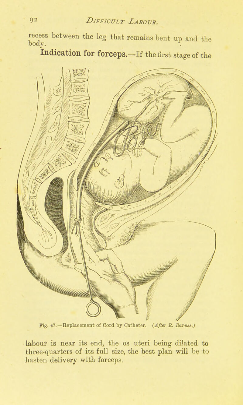 recess between the leg that remains bent up and the body. . Indication for forceps.—If the first stage of the Pig. 47.—Replacement of Cord by Catheter. (Afltr R. Bartus.) labour is near its end, the os uteri being dilated to three-quarters of its full size, the best plan will be to hasten delivery with forceps.