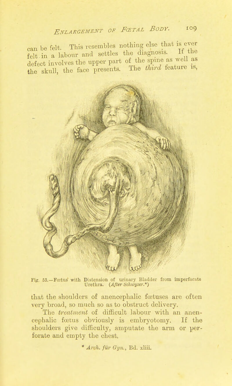 Enlargement of Fcetal Body. can be felt. This resembles nothing else that is evei felt in a labour and settles the diagnosis. If the defect involves the upper part of the spine as well as the skull, the face presents. The thh-d feature is, Fig. 53.—Foetus' with Distension of urinary Bladder from imperforato Urethra. {After Schwyzer.*) that the shoulders of anencephalic foetuses are often very broad, so much so as to obstruct delivery. The treatment of difficult labour with an anen- cephalic foetus obviously is embryotomy. If the shoulders give difficulty, amputate the arm or per- forate and empty the chest. * Arch, fiir Gyii., Bd. xliii.