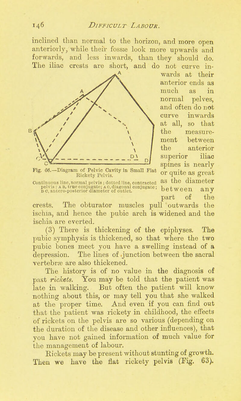 Fig. 66.—Diagram of Pelvic Cavity in Small Flat Rickety Pelvis. Continuous line,normal pelvis; dotted line, contracted pel V is; A B, true conj ugate; a 0, diagonal conj ugate; D 0, antero-posterior diameter of outlet. inclined than normal to the horizon, and more open anteriorly^ while their fossie look more upwards and forwards, and less inwards, than they should do. The iliac crests are short, and do not curve in- wards at their anterior ends as much as in normal pelves, and often do not curve inwards at all, so that the measure- ment between the anterior superior iliac spines is nearly or quite as great as the diameter between any part of the crests. The obtura^tor muscles pull outwards the ischia, and hence the pubic arch is widened and the ischia are everted. (3) There is thickening of the epiphyses. The pubic symphysis is thickened, so that where the two pubic bones meet you have a swelling instead of a depression. The lines of .junction between the sacral vertebrte are also thickened. The history is of no value in the diagnosis of past rickets. You may be told that the patient was late in walking. But often the patient will know nothing about this, or may tell you that she walked at the proper time. And even if you can find out that the patient was rickety in childhood, the effects of rickets on the pelvis are so various (depending on the duration of the disease and other influences), that you have not gained information of much value for the management of labour. Rickets may be present without stunting of growth. Then we have the flat rickety pelvis (Fig. 63).