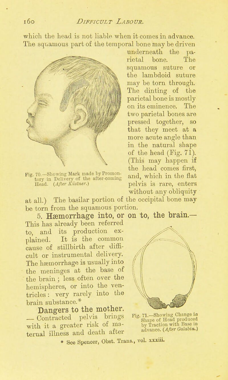 wliicli tlie head is not liable when it comes in advance. The squamous part of the temporal bone may be driven underneath the pa- rietal bone. The squamous suture or the lambdoid suture may be torn through. The dinting of the parietal bone is mostly on its eminence. The two parietal bones are pressed together, so that they meet at a more acute angle than in the natural shape of the head (Fig. 71). (This may happen if the head comes first, and, which in the flat pelvis is rare, enters without any obliquity at all.) The basilar portion of the occipital bone may be torn from the squamous portion. 5. Hsemorrhage into, or on to, the brain.— This has already been referred to, and its production ex- plained. It is the common cause of stillbirth after \iiffi- cult or instrumental delivery. The hsemorrhage is usually into the meninges at the base of the brain ; less often over the hemispheres, or into the ven- tricles : very rarely into the brain substance.* Dangers to the mother. _ Contracted pelvis brings with it a greater risk of ma- ternal ilbiess and death after * Soe Spencer, Obst. Traus. Fig. 70.—Showing Mark made by Promon- tory in Delivery of the after-coming Head. (^AJler Kustner.) Fi. 71.—Showing Ch.mgo in ° Sliape of Head produced by Traction with Rase iu advance. (AfUr Galabin.) vol. xxxiiL