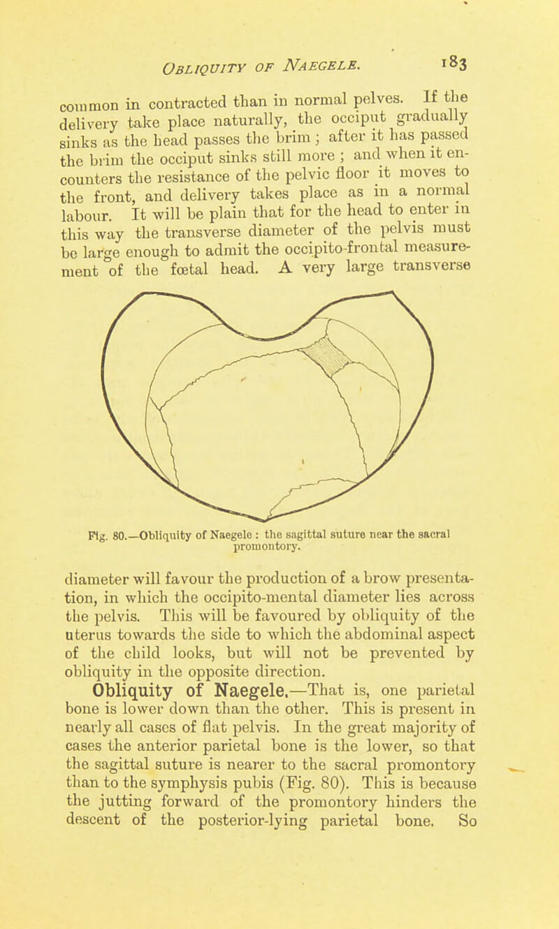 common in contracted than in normal pelves. If the delivery take place naturally, the occiput gradually sinks as the head passes tlie brim ; after it has passed the brim the occiput sinks still more ; and when it en- counters the resistance of the pelvic floor it moves to the front, and delivery takes place as m a normal labour. It will be plain that for the head to enter m this way the transverse diameter of the pelvis must be large enough to admit the occipito-frontal measure- ment of the fcEtal head. A very large transverse Ffg. 80.—Obliquity of Naegelo : tlie sagittal suture near the sacral promontory. diameter will favour the production of a brow presenta- tion, in which the occipito-mental diameter lies across the pelvis. This will be favoured by obliquity of the uterus towards the side to which the abdominal aspect of the child looks, but will not be prevented by obliquity in the opposite direction. Obliquity of Naegele.—That is, one parietal bone is lower down than the other. This is present in nearly all cases of flat pelvis. In the great majority of cases the anterior parietal bone is the lower, so that the sagittal suture is nearer to the sacral promontory than to the symphysis pubis (Fig. 80). This is because the jutting forward of the promontory hinders the descent of the posterior-lying parietal bone. So