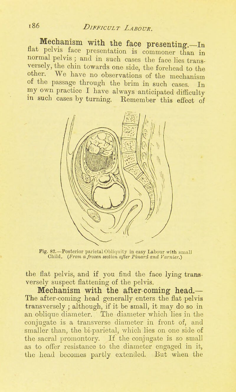 Mechanism with the face presenting.—In flat pelvis face presentation is commoner than in normal pelvis ■ and in such cases tlie face lies trans- versely, the chin towards one side, the forehead to the other. We have no observations of the mechanism of the passage through the brim in such cases. In my own practice I have always anticipated difficulty in such cases by turning. Remember this effect of Fig. 82.—Posterior parietal Obliquity in easy Labour with smalJ Child. (From a frozen section after Pinard and Varnier.) the flat pelvis, and if you find the face lying trana- versely suspect flattening of the pelvis. Mechanism with the after-coming head.— The after-coming head generally enters the flat pelvis transversely ; although, if it be small, it may do so in an oblique diameter. The diameter which lies in the conjugate is a transverse diameter in front of, and smaller than, the bi-parietal, wljich lies on one side of the sacral promontory. If tlie conjugate is so small as to offer resistance to the diameter engaged in it, the head becomes partly extended. But when the