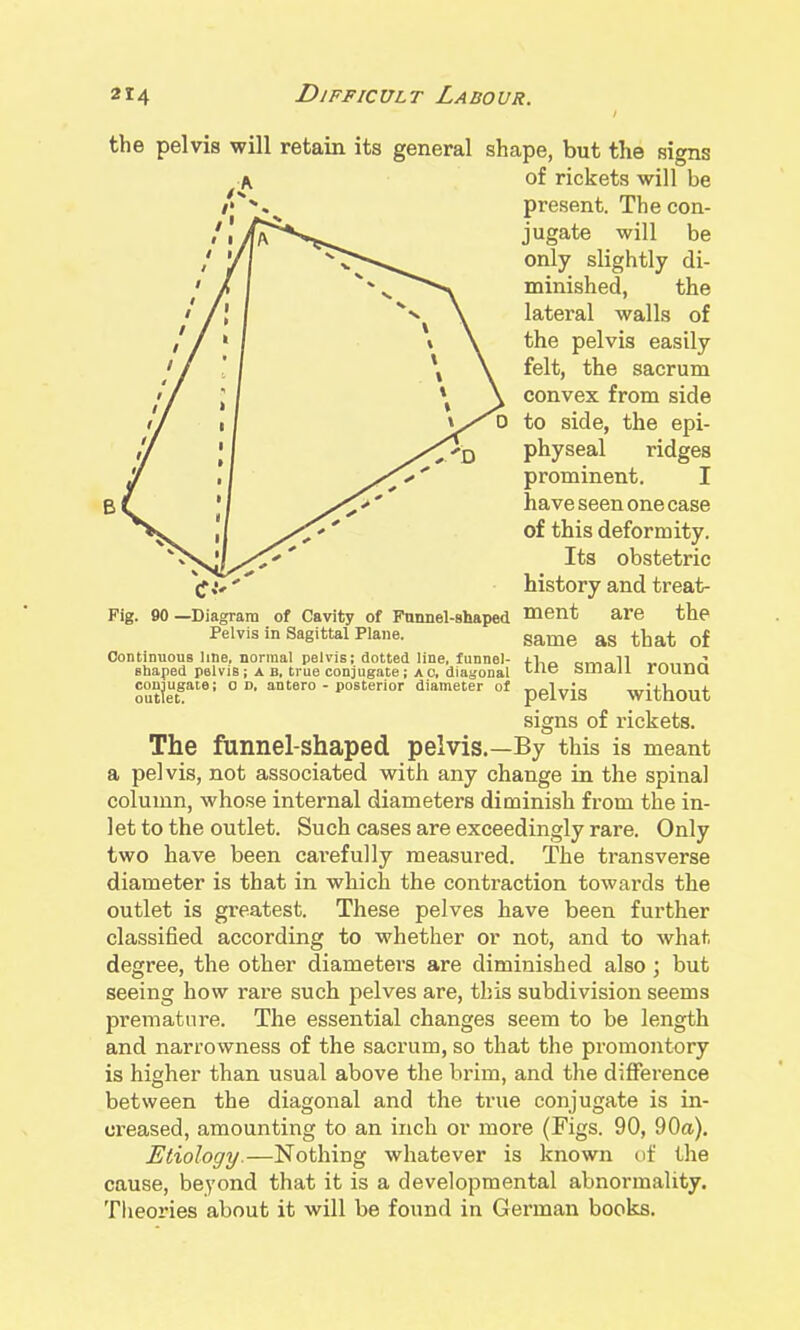 Fig. 90 —Diagram of Cavity of Fnnnel-shaped Pelvis In Sagittal Plane. the pelvis will retain its general shape, but the signs of rickets will be present. The con- jugate will be only slightly di- minished, the lateral walls of the pelvis easily felt, the sacrum convex from side to side, the epi- physeal ridges prominent. I have seen one case of this deformity. Its obstetric history and treat- ment are the same as that of Continuous line, normal pelvis; dotted line, funnel- „rv.o11 ■^r~.,-.-^A shaped psivis; A B. true conjugate; ao, diagonal ^^^ hUldU roUDu conjugate; o n, antero - posterior diameter of pgi^jg without signs of rickets. The funnel-shaped pelvis.—By this is meant a pelvis, not associated with any change in the spinal column, whose internal diameters diminish from the in- let to the outlet. Such cases are exceedingly rare. Only two have been carefully measured. The transverse diameter is that in which the contraction towards the outlet is greatest. These pelves have been further classified according to whether or not, and to what degree, the other diameters are diminished also ; but seeing how rare such pelves are, this subdivision seems premature. The essential changes seem to be length and narrowness of the sacrum, so that the promontory is higher than usual above the brim, and the difference between the diagonal and the true conjugate is in- creased, amounting to an inch or more (Figs. 90, 90a), Etiology.—Nothing whatever is known df the cause, beyond that it is a developmental abnormality. Theories about it will be found in German books.