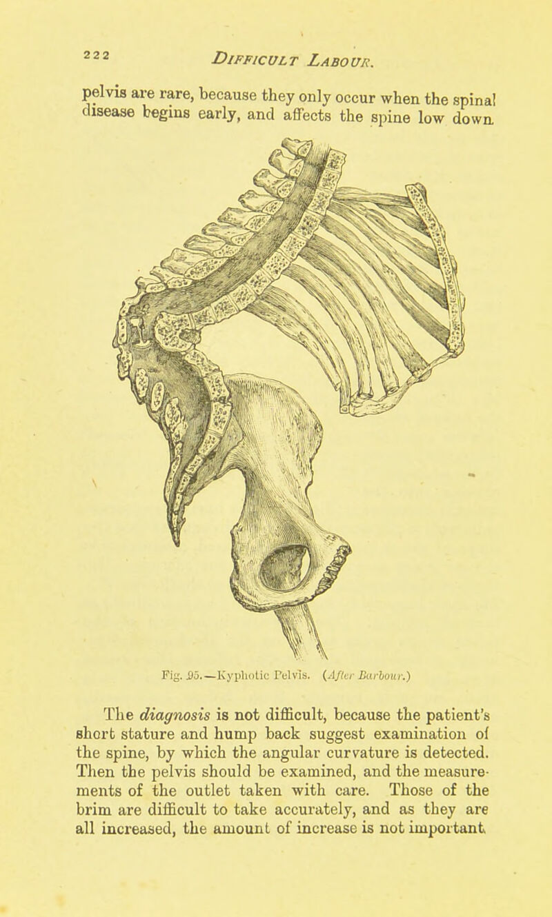 pelvis are rare, because they only occur when the spinal disease begins early, and affects the spine low down \ Fig. i)o.—Kyphotic rdvis. {AJkr Darhour.) The diagnosis is not difficult, because the patient's short stature and hump back suggest examination of the spine, by which the angular curvature is detected. Then the pelvis should be examined, and the measure- ments of the outlet taken with care. Those of the brim are difficult to take accurately, and as they are all increased, the amount of increase is not important