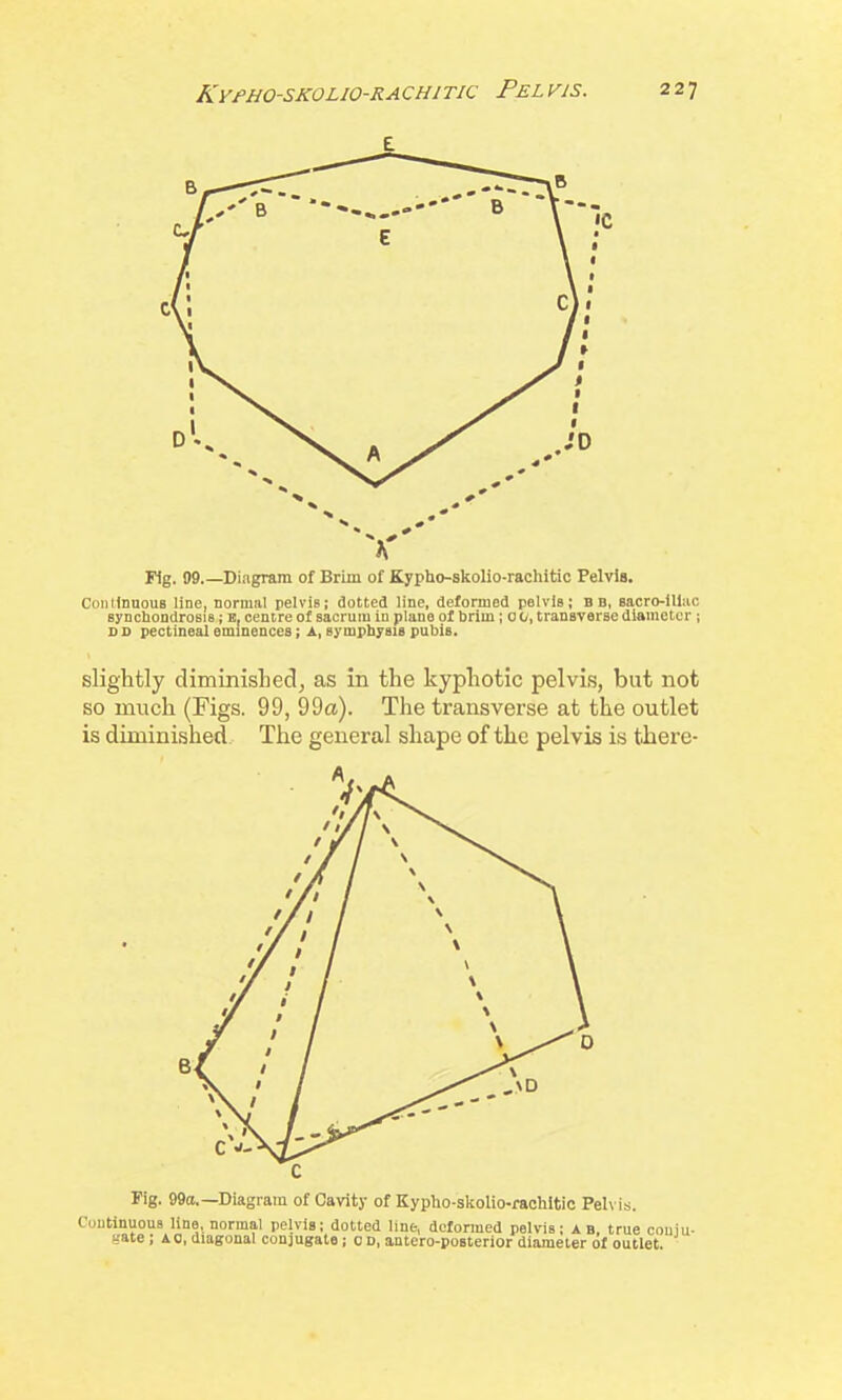 slightly diminisLed, as in the kyphotic pelvis, but not so much (Figs. 99, 99a). The transverse at the outlet is diminished The general shape of the pelvis is tliere- Fig. 99o.—Diagram of Cavity of Kypho-slioUo-rachltic Pelv is. Coutinuous line, normal pelvis; dotted lint, deformed pelvis; A B, true couiu- gate ; ao, diagonal conjugate; c D, antero-poBterior diameter of outlet.