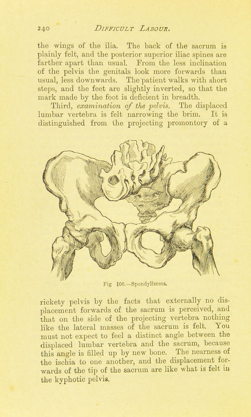 the wings of the ilia. The back of the sacrum is plainly felt, and the posterior superior iliac spines are farther apart than iisual. From the less inclination of the pelvis the genitals look more forwards than usual, less downwards. The patient walks with short steps, and the feet are slightly inverted, so that the mark made by the foot is deficient in breadth. Third, examination of the 'pelvis. The displaced lumbar vertebra is felt narrowing the brim. It is distinguished from the projecting promontory of a Fig 106.—Spondylizema. rickety pelvis by the facts that externally no dis- placement forwards of the sacrum is perceived, and that on the side of the projecting vertebra nothing like the lateral masses of the sacrum is felt. You must not expect to feel a distinct angle between the displaced lumbar vertebra and the sacrum, because this angle is filled up by new bone. The nearness of the ischia to one another, and the displacement for- wards of the tip of the sacrum are like what is felt iu the kyphotic pelvis.