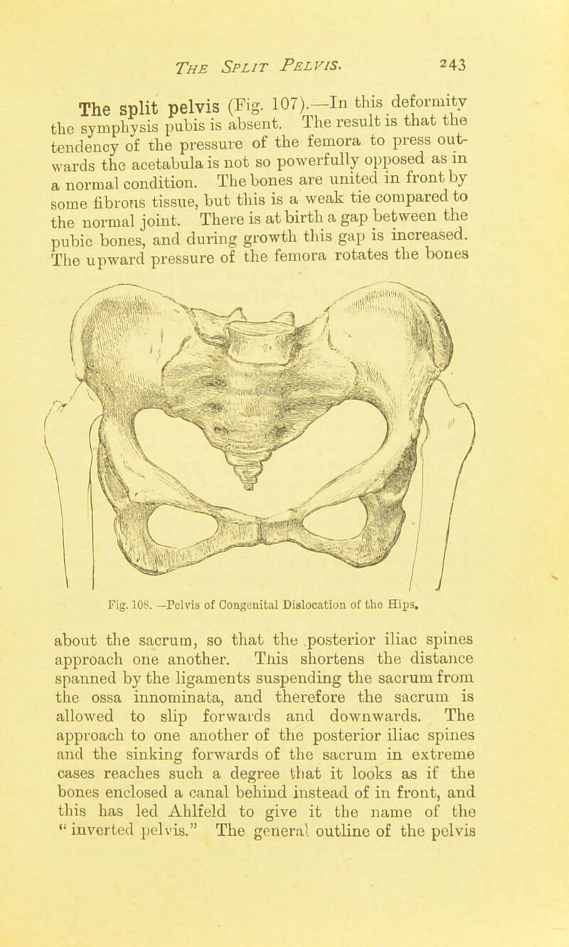 The split pelvis (Fig. 107).—In this deformity the symphysis pubis is absent. The result is that the tendency of the pressure of the femora to press out- wards the acetabulais not so powerfully opposed as in a normal condition. The bones are united in front by some fibrons tissue, but this is a weak tie compared to the normal joint. There is at birth a gap between the pubic bones, and during growth this gap is increased. The upward pressure of the femora rotates the bones Fig. lOS. —Pelvis of Congenital Dislocation of the Hips. about the sacrum, so that the posterior iliac spines approach one another. Tliis shortens the distance spanned by the ligaments suspending the sacrum from the ossa innominata, and therefore the sacrum is allowed to slip forwards and downwards. The approach to one another of the posterior iliac spines and the sinking forwards of the sacrum in extreme cases reaches such a degree that it looks as if the bones enclosed a canal behind instead of in front, and this has led Ahlfeld to give it the name of the inverted pelvis. The general outline of the pelvis