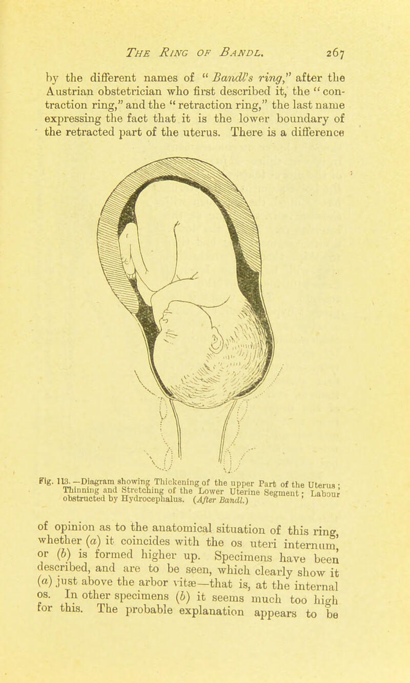 by the different names of  Bandl's ring, after the Austrian obstetrician who first described it, the  con- traction ring, and the  retraction ring, the last name expressing the fact that it is the lower boundary of the retracted part of the uterus. There is a difference of opinion as to the anatomical situation of this rin^ whether {a) it coincides with the os uteri internum' or (6) is formed higher up. Specimens have been described, and are to be seen, which clearly show it {a) just above the arbor ^-itse—that is, at the internal OS. In other specimens {b) it seems much too high for this. The probable explanation appears to be