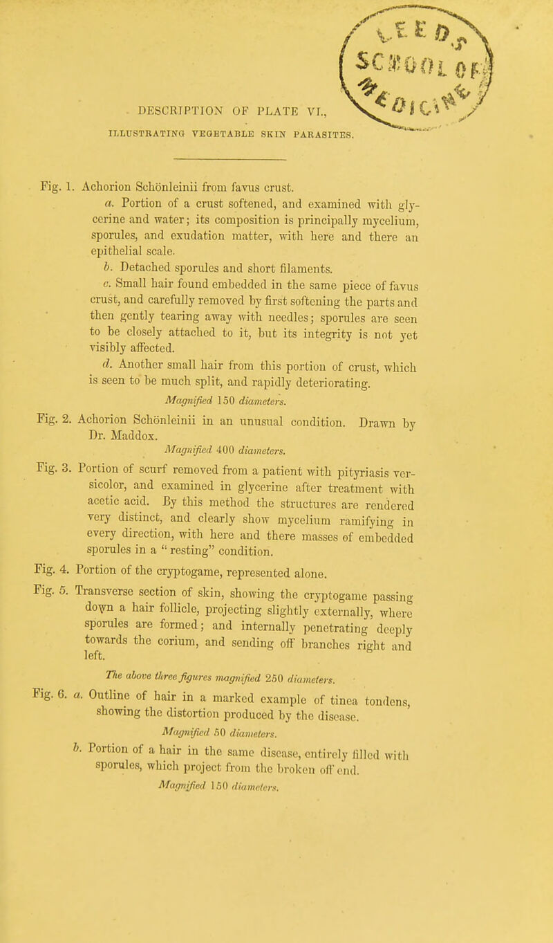 ILLUSTRATING VEGETABLE SKIN PARASITES Fig. 1. Acliorion Schonleinii from favus crust. a. Portion of a crust softened, and examined with gly- cerine and water; its composition is principally mycelium, sporules, and exudation matter, with here and there an epithelial scale. b. Detached sporules and short filaments. c. Small hair found embedded in the same piece of favus crust, and carefully removed by first softening the parts and then gently tearing away with needles; sporules are seen to be closely attached to it, but its integrity is not yet visibly aiFected. d. Another small hair from tliis portion of crust, which is seen to be much split, and rapidly deteriorating. Magnified 150 diameters. Fig. 2. Achorion Schonleinii in an unusual condition. Drawn by Dr. Maddox. Magnified 400 diameters. Fig. 3. Portion of scurf removed from a patient with pityriasis ver- sicolor, and examined in glycerine after treatment with acetic acid. By this method the structures are rendered very distinct, and clearly show mycelium ramifying in every direction, with here and there masses of embedded sporules in a  resting condition. Fig. 4. Portion of the cryptogame, represented alone. Fig. 5. Transverse section of skin, showing the cryptogame passing dovn a hair follicle, projecting slightly externally, where sporules are formed; and internally penetrating deeply towards the corium, and sending off branches right and left. Tlie above three figures magnified 250 diameters. Fig. 6. a. Outline of hair in a marked example of tinea tondens, showing the distortion produced by the disease. M<.tg7iified 60 diameters, b. Portion of a hair in the same disease, entirely filled with sporules, which project from the broken ofi'oiul. Magnified 150 diameters.