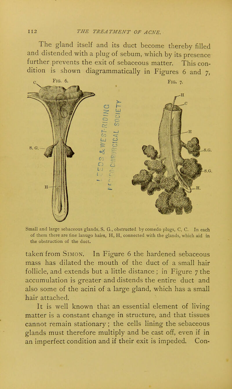 The gland itself and its duct become thereby filled and distended with a plug of sebum, which by its presence further prevents the exit of sebaceous matter. This con- dition is shown diagrammatically in Figures 6 and 7, Small and large sebaceous glands, S. G., obstructed by comedo plugs, C, C. In each of them there are fine lanugo hairs, H, H, connected with the glands, which aid in the obstruction of the duct. taken from Simon. In Figure 6 the hardened sebaceous mass has dilated the mouth of the duct of a small hair follicle, and extends but a little distance ; in Figure 7 the accumulation is greater and distends the entire duct and also some of the acini of a large gland, which has a small hair attached. It is well known that an essential element of living matter is a constant change in structure, and that tissues cannot remain stationary ; the cells lining the sebaceous glands must therefore multiply and be cast off, even if in an imperfect condition and if their exit is impeded. Con-