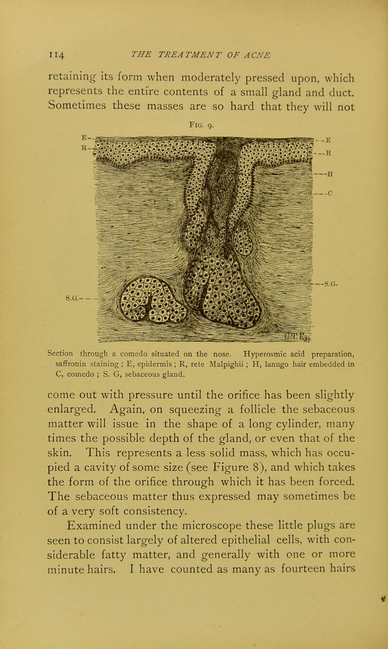 retaining its form when moderately pressed upon, which represents the entire contents of a small gland and duct. Sometimes these masses are so hard that they will not Fig. 9. Section through a comedo situated on the nose. Hyperosmic acid preparation, saffronin staining ; E, epidermis ; R, rete Malpighii; H, lanugo hair embedded in C, comedo ; S. G, sebaceous gland. come out with pressure until the orifice has been slightly enlarged. Again, on squeezing a follicle the sebaceous matter will issue in the shape of a long cylinder, many times the possible depth of the gland, or even that of the skin. This represents a less solid mass, which has occu- pied a cavity of some size (see Figure 8), and which takes the form of the orifice through which it has been forced. The sebaceous matter thus expressed may sometimes be of a very soft consistency. Examined under the microscope these little plugs are seen to consist largely of altered epithelial cells, with con- siderable fatty matter, and generally with one or more minute hairs. I have counted as many as fourteen hairs