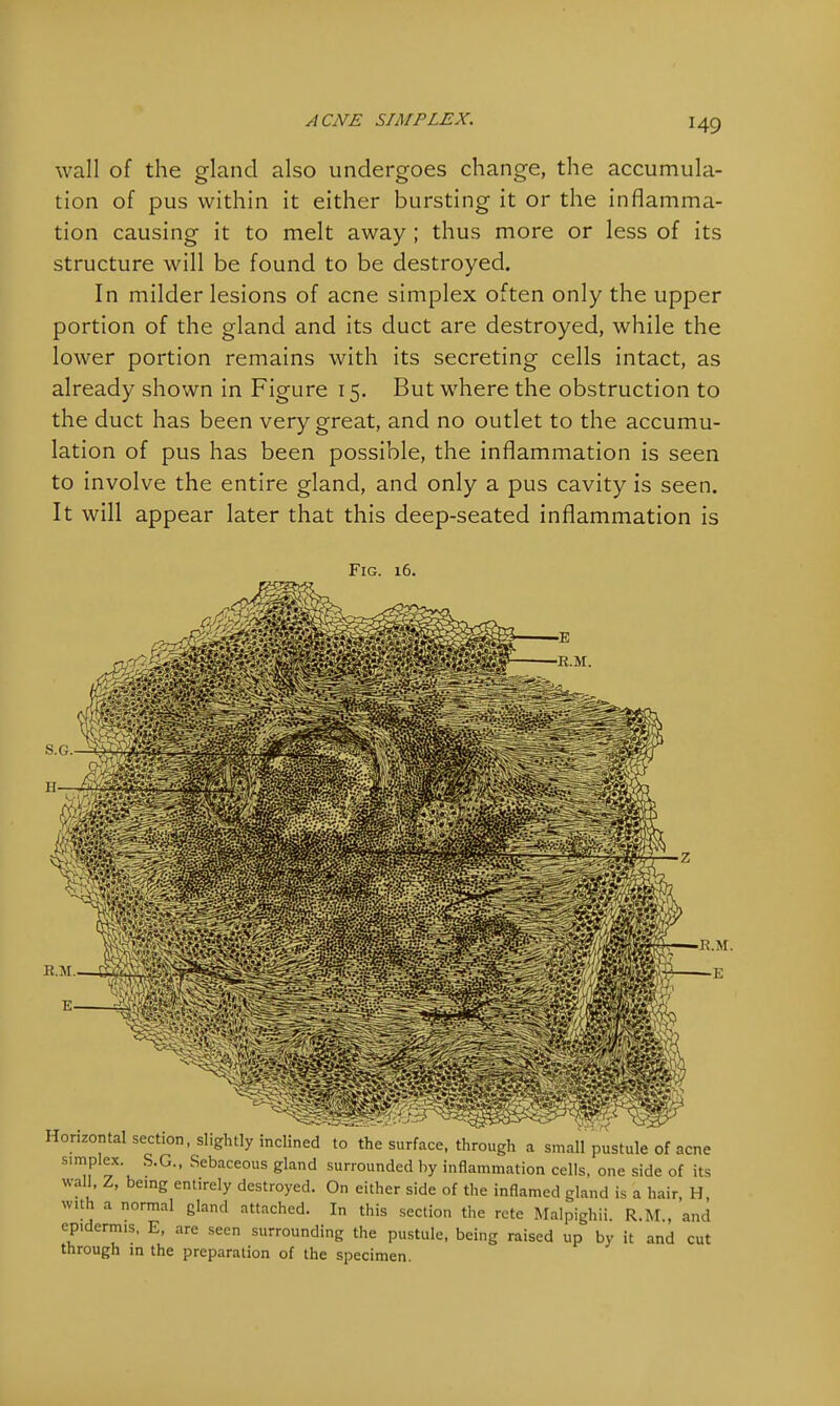 wall of the gland also undergoes change, the accumula- tion of pus within it either bursting it or the inflamma- tion causing it to melt away ; thus more or less of its structure will be found to be destroyed. In milder lesions of acne simplex often only the upper portion of the gland and its duct are destroyed, while the lower portion remains with its secreting cells intact, as already shown in Figure 15. But where the obstruction to the duct has been very great, and no outlet to the accumu- lation of pus has been possible, the inflammation is seen to involve the entire gland, and only a pus cavity is seen. It will appear later that this deep-seated inflammation is Fig. 16. Horizontal section, slightly inclined to the surface, through a small pustule of acne simplex. S.G., Sebaceous gland surrounded by inflammation cells, one side of its wall, Z, being entirely destroyed. On either side of the inflamed gland is a hair, H, with a normal gland attached. In this section the rete Malpighii. R.M., and epidermis, E, are seen surrounding the pustule, being raised up by it and cut through in the preparation of the specimen.
