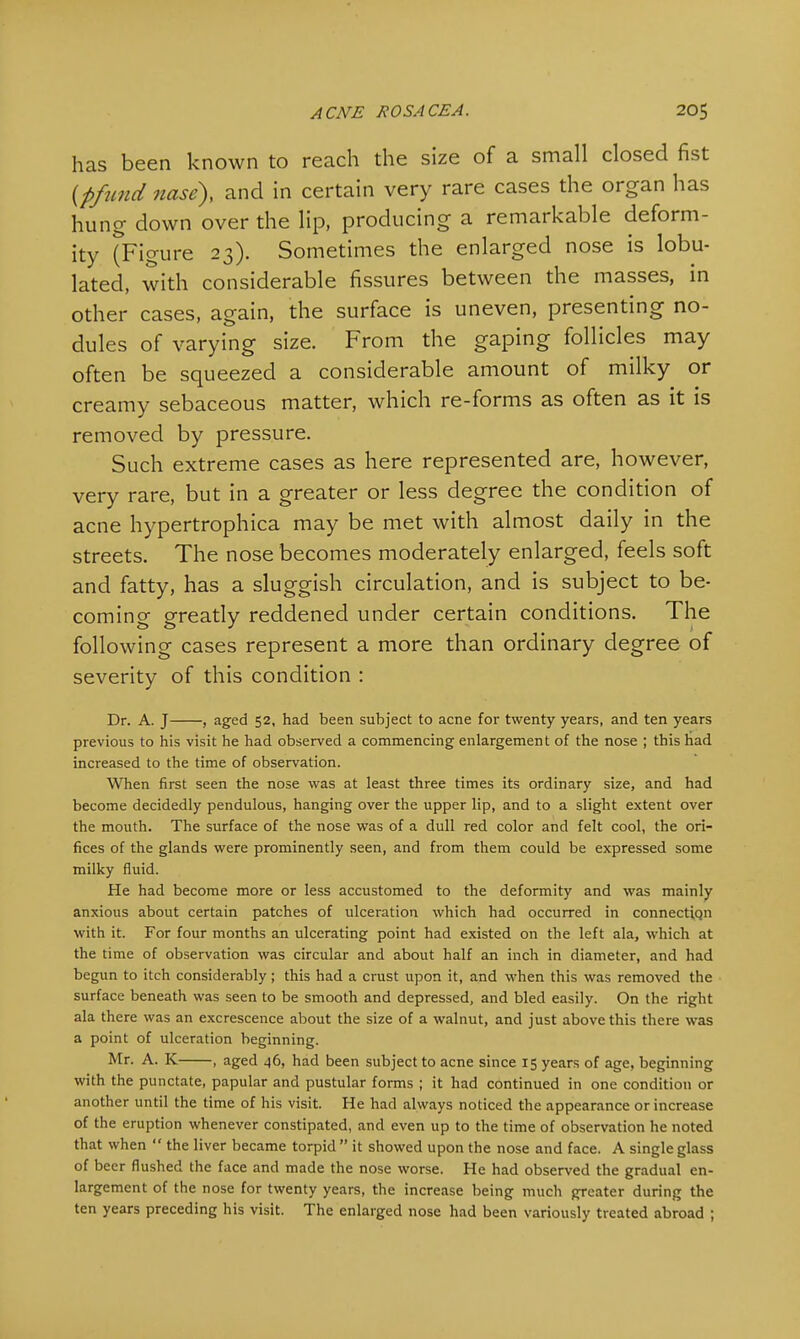 has been known to reach the size of a small closed fist {pfund nose), and in certain very rare cases the organ has hung down over the lip, producing a remarkable deform- ity (Figure 23). Sometimes the enlarged nose is lobu- lated, with considerable fissures between the masses, in other cases, again, the surface is uneven, presenting no- dules of varying size. From the gaping follicles may often be squeezed a considerable amount of milky or creamy sebaceous matter, which re-forms as often as it is removed by pressure. Such extreme cases as here represented are, however, very rare, but in a greater or less degree the condition of acne hypertrophica may be met with almost daily in the streets. The nose becomes moderately enlarged, feels soft and fatty, has a sluggish circulation, and is subject to be- coming greatly reddened under certain conditions. The following cases represent a more than ordinary degree of severity of this condition : Dr. A. J , aged 52, had been subject to acne for twenty years, and ten years previous to his visit he had observed a commencing enlargement of the nose ; this had increased to the time of observation. When first seen the nose was at least three times its ordinary size, and had become decidedly pendulous, hanging over the upper lip, and to a slight extent over the mouth. The surface of the nose was of a dull red color and felt cool, the ori- fices of the glands were prominently seen, and from them could be expressed some milky fluid. He had become more or less accustomed to the deformity and was mainly anxious about certain patches of ulceration which had occurred in connectiqn with it. For four months an ulcerating point had existed on the left ala, which at the time of observation was circular and about half an inch in diameter, and had begun to itch considerably ; this had a crust upon it, and when this was removed the surface beneath was seen to be smooth and depressed, and bled easily. On the right ala there was an excrescence about the size of a walnut, and just above this there was a point of ulceration beginning. Mr. A. K , aged 46, had been subject to acne since 15 years of age, beginning with the punctate, papular and pustular forms ; it had continued in one condition or another until the time of his visit. He had always noticed the appearance or increase of the eruption whenever constipated, and even up to the time of observation he noted that when  the liver became torpid  it showed upon the nose and face. A single glass of beer flushed the face and made the nose worse. He had observed the gradual en- largement of the nose for twenty years, the increase being much greater during the ten years preceding his visit. The enlarged nose had been variously treated abroad ;