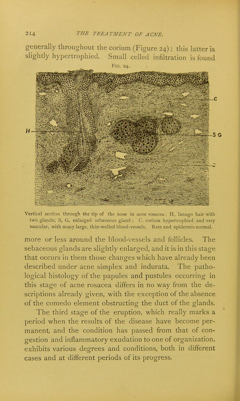 generally throughout the corium (Figure 24); this latter is slightly hypertrophied. Small celled infiltration is found Fig. 24. Vertical section through the tip of the nose in acne rosacea: H, lanugo hair with two glands; S, G, enlarged sebaceous gland ; C, corium hypertrophied and very vascular, with many large, thin-walled blood-vessels. Rete and epidermis normal. more or less around the blood-vessels and follicles. The sebaceous glands are slightly enlarged, and it is in this stage that occurs in them those changes which have already been described under acne simplex and indurata. The patho- logical histology of the papules and pustules occurring in this stage of acne rosacea differs in no way from the de- scriptions already given, with the exception of the absence of the comedo element obstructing the duct of the glands. The third stage of the eruption, which really marks a period when the results of the disease have become per- manent, and the condition has passed from that of con- gestion and inflammatory exudation to one of organization, exhibits various degrees and conditions, both in different cases and at different periods of its progress.