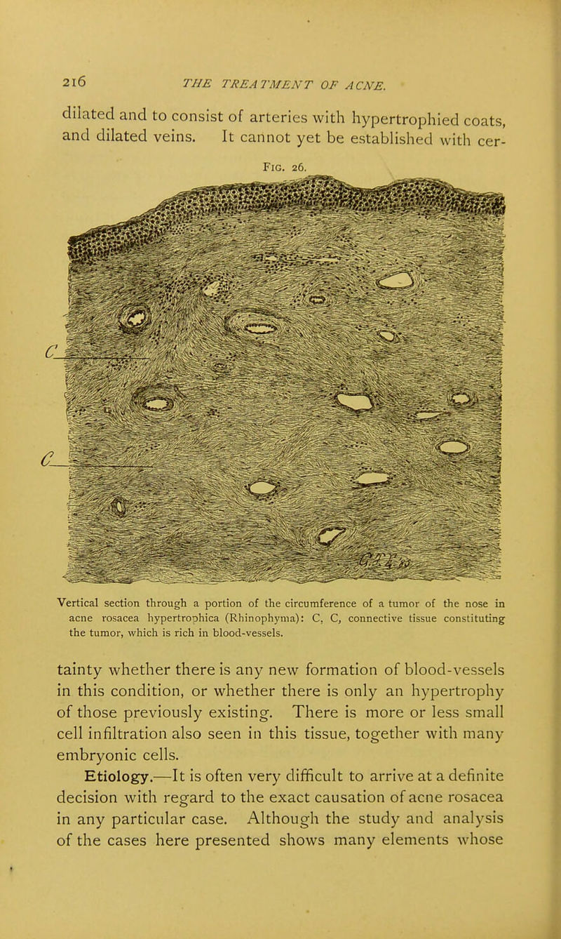 dilated and to consist of arteries with hypertrophied coats, and dilated veins. It cannot yet be established with cer- Fig. 26. Vertical section through a portion of the circumference of a tumor of the nose in acne rosacea hypertrophica (Rhinophyma): C, C, connective tissue constituting the tumor, which is rich in blood-vessels. tainty whether there is any new formation of blood-vessels in this condition, or whether there is only an hypertrophy of those previously existing. There is more or less small cell infiltration also seen in this tissue, together with many embryonic cells. Etiology.—It is often very difficult to arrive at a definite decision with regard to the exact causation of acne rosacea in any particular case. Although the study and analysis of the cases here presented shows many elements whose