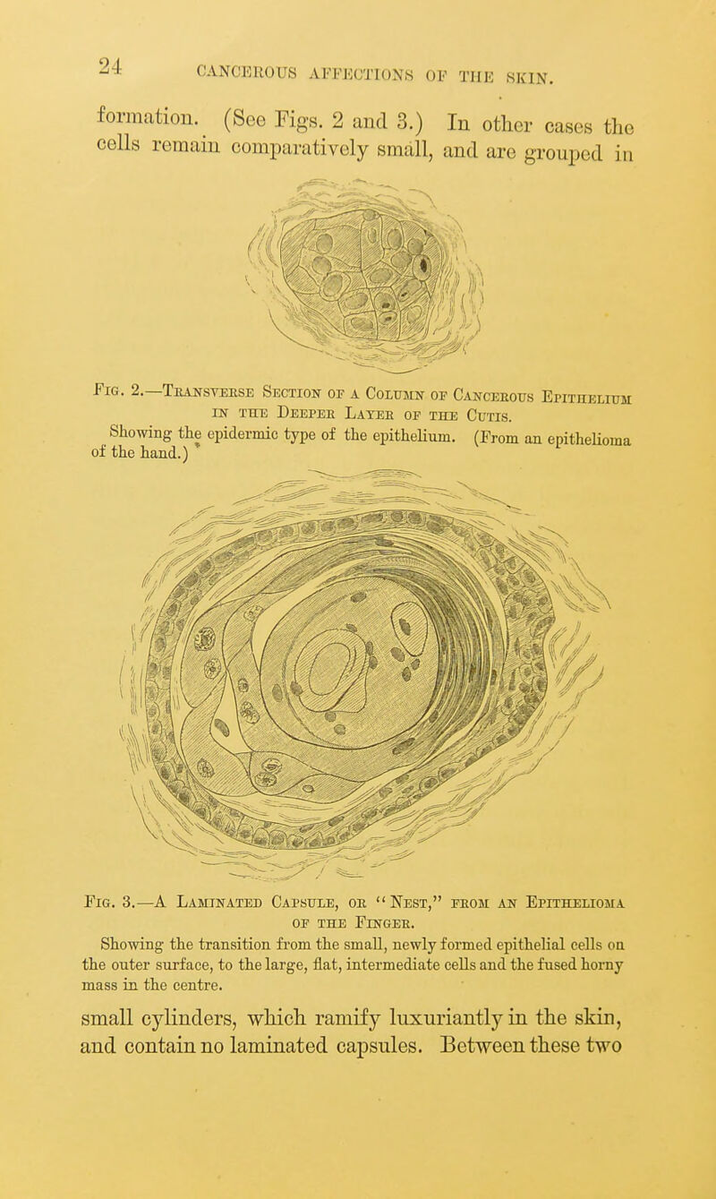 formation. (See Figs. 2 and 3.) In other cases the cells remain comparatively small, and are grouped in Fig. 2.—Teansveese Section of a Column of Canceeous Epithelitim IN THE DeEPEE LaYEE OF THE CUTIS. Showing the epidermic type of the epithelium. (From an epitheUoma of the hand.) Fig. 3.—A Laminated Capsule, oe  Nest, feom an Epithelioma OF THE FiNGEE. Showing the transition from the small, newly formed epithelial cells on the outer surface, to the large, flat, intermediate cells and the fused horny mass in the centre. small cylinders, which ramify luxuriantly in the skin, and contain no laminated capsules. Between these two