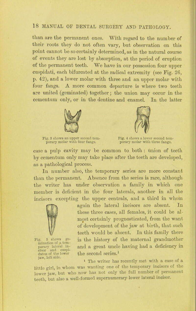 than are tbe permanent ones. With regard to the number of their roots they do not often vary, but observation on this point cannot be so certainly determined, as in the natural course of events they are lost by absorption, at the period of eruption of the permanent teeth. We have in our possession four upper cuspidati, each bifurcated at the radical extremity (see Fig. 26, p. 42), and a lower molar with three and an upper molar with four fangs. A more common departure is where two teeth are vmited (geminated) together; the union may occur in the cementum only, or in the dentine and enamel. In the latter Fig. 3 shows an upper second tern- Pig. 4 shows a lower second tem- porary molar with four fangs. porary molar with three fangs. case a pulp cavity may be common to both : union of teeth by cementum only may take place after the teeth are developed, as a pathological process. In number also, the temporary series are more constant than the permanent. Absence from the series is rare, although the writer has under observation a family in which one member is deficient in the four laterals, another in all the incisors excepting the upper centrals, and a third in whom asrain the lateral incisors are absent. In these three cases, all females, it could be al- most certainly prognosticated, from the want of development of the jaw at birth, that such teeth would be absent. In this family there Fig. 5 shows ge- ^}^q history of the maternal grandmother mination of a tem- ,1.11 i n • porary lateral in- qj^^ q. great uncle having had a deficiency m cisor and cuspi- , • 1 datus of the lower the second series.^ jaw, left side. * The writer has recently met with a case or a little girl, in whom was wanting one of the temporary incisors of the lower jaw, but who now has not only the full number of permanent teeth, but also a well-formed supernumerary lower lateral incisor.