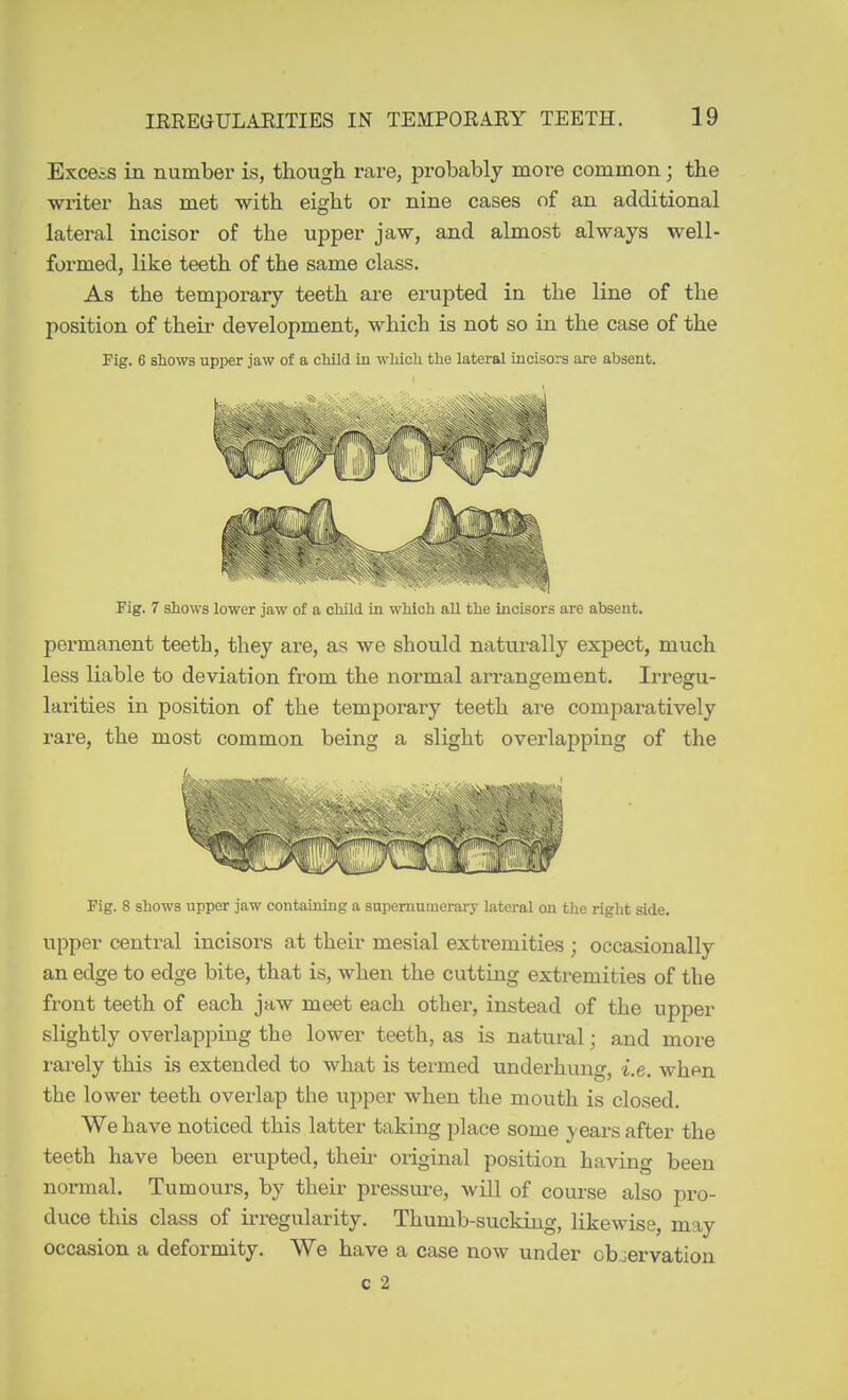 Excels in number is, though rare, probably more common; the writer has met with eight or nine cases of an additional lateral incisor of the upper jaw, and almost always well- formed, like teeth of the same class. As the temporary teeth are erupted in the line of the position of their development, which is not so in the case of the Fig. 6 shows upper jaw of a cMld in wMcli the lateral incisors are absent. Fig. 7 shows lower jaw of a child in which all the incisors are absent. permanent teeth, they are, as we should naturally expect, much less liable to deviation from the normal arrangement. Irregu- larities in position of the temporary teeth are comparatively rare, the most common being a slight overlapping of the Fig. 8 shows upper jaw containing a supernumerary lateral on the right side. \ipper central incisors at their mesial exti'emities ; occasionally an edge to edge bite, that is, when the cutting extremities of the front teeth of each jaw meet each other, instead of the upper slightly overlapping the lower teeth, as is natural; and more rarely this is extended to what is termed underhung, i.e. whpn the lower teeth overlap the upper when the mouth is closed. We have noticed this latter taking place some years after the teeth have been erupted, then- original position having been normal. Tumours, by their pressure, will of course also pro- duce this class of irregularity. Thumb-sucking, likewise, may occasion a deformity. We have a case now under observation c 2