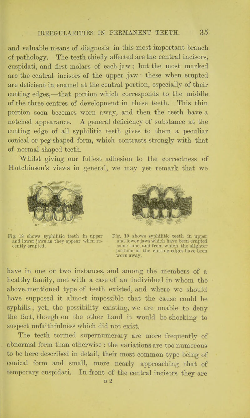 and valuable means of diagnosis in this most important branch of pathology. The teeth chiefly affected are the central incisors, cuspidati, and first molars of each jaw; but the most marked are the central incisors of the upper jaw : these when erupted are deficient in enamel at the central portion, especially of their cutting edges,—that portion which corresponds to the middle of the three centres of development in these teeth. This thin portion soon becomes worn away, and then the teeth have a notched appearance. A general deficiency of substance at the cutting edge of all syphilitic teeth gives to them a peculiar conical or peg-shaped form, which contrasts strongly with that of normal shaped teeth. Whilst giving our fullest adhesion to the correctness of Hutchinson's views in general, we may yet remark that we Fig. 18 shows syphilitic teeth in upper and lower jaws as they appear when re- cently erupted. Fig. 19 shows syphilitic teeth in upper and lower jaws which have been erui)ted some time, and from which the sligliter portions at the cutting edges have been worn away. have in one or two instances, and. among the members of a healthy family, met with a case of an individual in whom the above-mentioned type of teeth existed, and where we should have supposed it almost impossible that the cause could be syphilis; yet, the possibility existing, we are unable to deny the fact, though on the other hand it would be shocking to suspect unfaithfulness which did not exist. The teeth termed supernumei'aiy are more frequently of abnormal form than otherwise : the variations are too numerous to be here described in detail, their most common type being of conical form and small, more nearly approaching that of temporary cuspidati. In front of the central incisors they are D 2