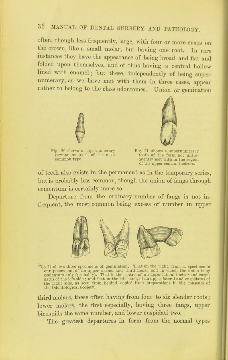 often, though less frequently, large, with four or more cusps on the crown, like a small molar, but having one root. In rare instances they have the appearance of being broad and flat and folded upon themselves, and of thus having a central hollow lined with enamel; but these, independently of being super- numerary, as we have met with them in three cases, appear rather to belong to the class odontomes. Union or gemination Fig. 20 shows a supernumerary Fig. 21 shows a supernumerary permanent tooth of the most tooth of the form not unfre- common tyjje. quently met with in the region of the upper central incisors. of teeth also exists in the permanent as in the temporary series, but is probably less common, though the union of fangs through cementum is certainly more so. Departure from the ordinary number of fangs is not in- frequent, the most common being excess of number in upper Fig. 22 shows three specimens of gemination. That on the right, from a specimen in our possession, of an upper second and third molar, and in which the union is by cementum only (probably). That in the centre, of an upper lateral incisor and cuspi- datns of the left side ; and that on the left hand, of an upper lateral and cuspidatus of the right side, as seen from behind, copied from preparations in the museum of the Odontological Society. third molars, these often having from four to six slender roots; lower molars, the first especially, having three fangs, upper bicuspids the same number, and lower cuspidati two. The greatest departures in form from the normal types