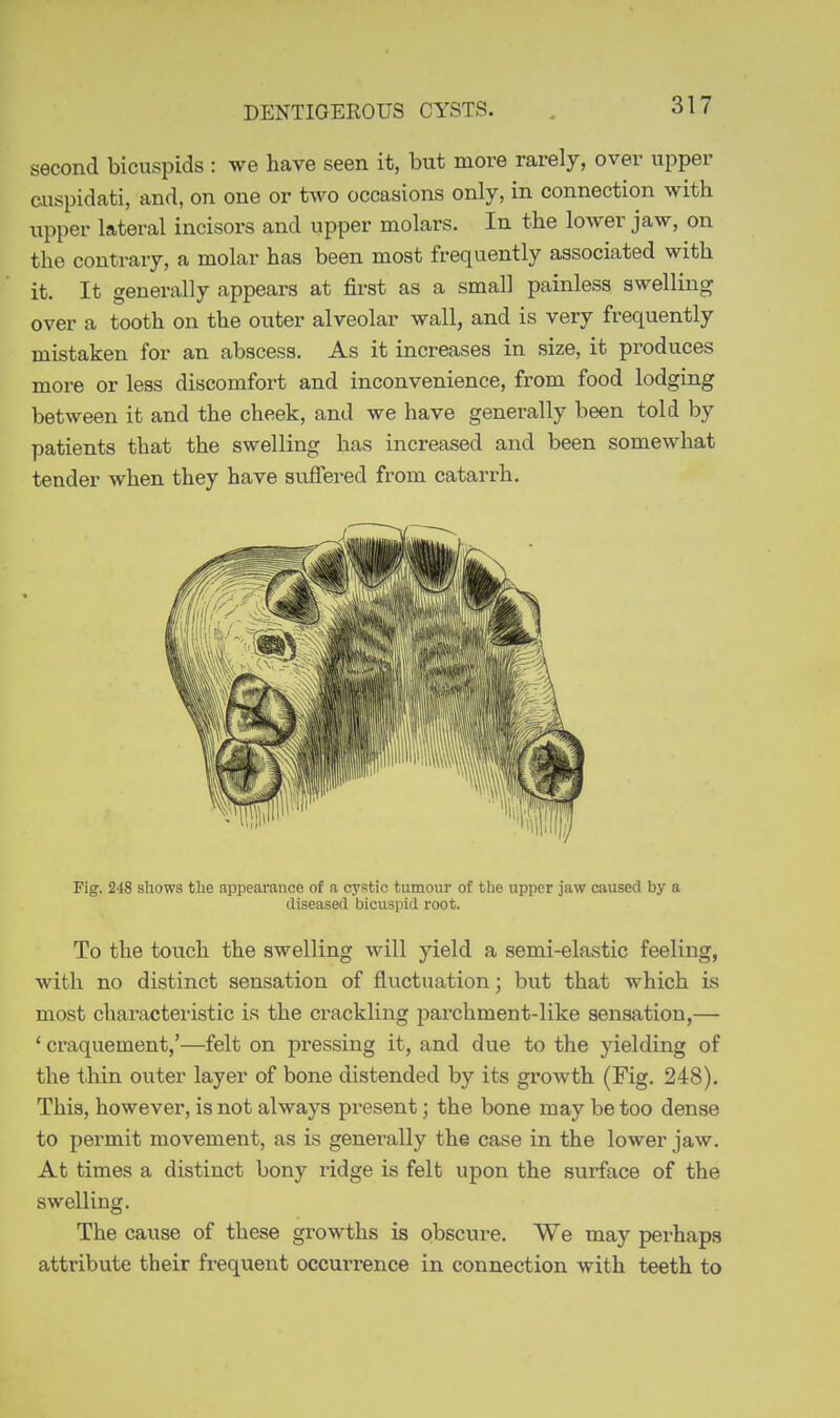 second bicuspids : we have seen it, but more rarely, over upper cuspidati, and, on one or two occasions only, in connection with upper lateral incisors and upper molars. In the lower jaw, on the contrary, a molar has been most frequently associated with it. It generally appears at first as a small painless swelling over a tooth on the outer alveolar wall, and is very frequently mistaken for an abscess. As it increases in size, it produces more or less discomfort and inconvenience, from food lodging between it and the cheek, and we have generally been told by patients that the swelling has increased and been somewhat tender when they have suffered from catarrh. Pig. 248 shows the appearance of a cystic tumour of the upper jaw caused by a diseased bicuspid root. To the touch the swelling will yield a semi-elastic feeling, with no distinct sensation of fluctuation; but that which is most characteristic is the crackling parchment-like sensation,— ' craquement,'—felt on pressing it, and due to the jdelding of the t.hin outer layer of bone distended by its growth (Fig. 248). This, however, is not always present; the bone may be too dense to permit movement, as is generally the case in the lower jaw. At times a distinct bony ridge is felt upon the surface of the swelling. The cause of these growths is obscure. We may perhaps attribute their frequent occurrence in connection with teeth to