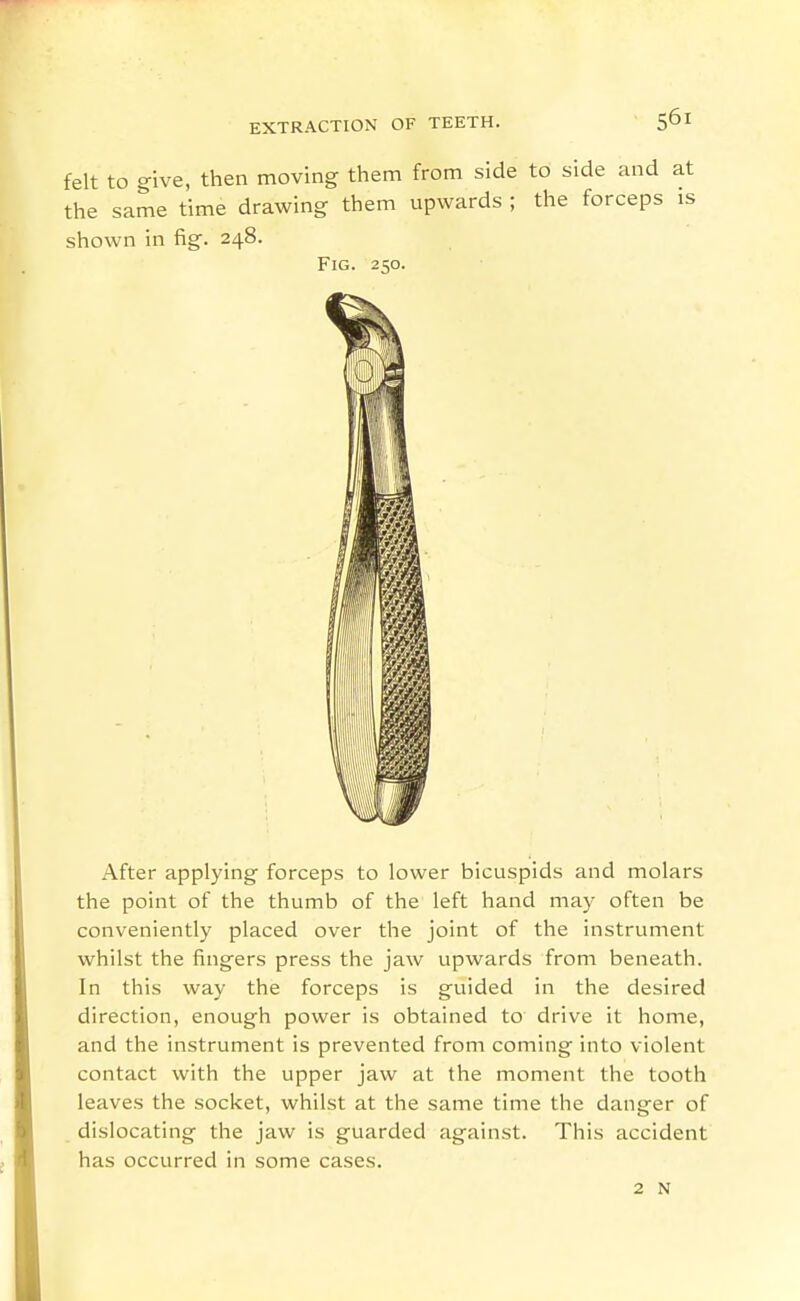 felt to give, then moving them from side to side and at the same time drawing them upwards ; the forceps is shown in fig. 248. Fig. 250. After applying forceps to lower bicuspids and molars the point of the thumb of the left hand may often be conveniently placed over the joint of the instrument whilst the fingers press the jaw upwards from beneath. In this way the forceps is guided in the desired direction, enough power is obtained to drive it home, and the instrument is prevented from coming into violent contact with the upper jaw at the moment the tooth leaves the socket, whilst at the same time the danger of dislocating the jaw is guarded against. This accident has occurred in some cases. 2 N