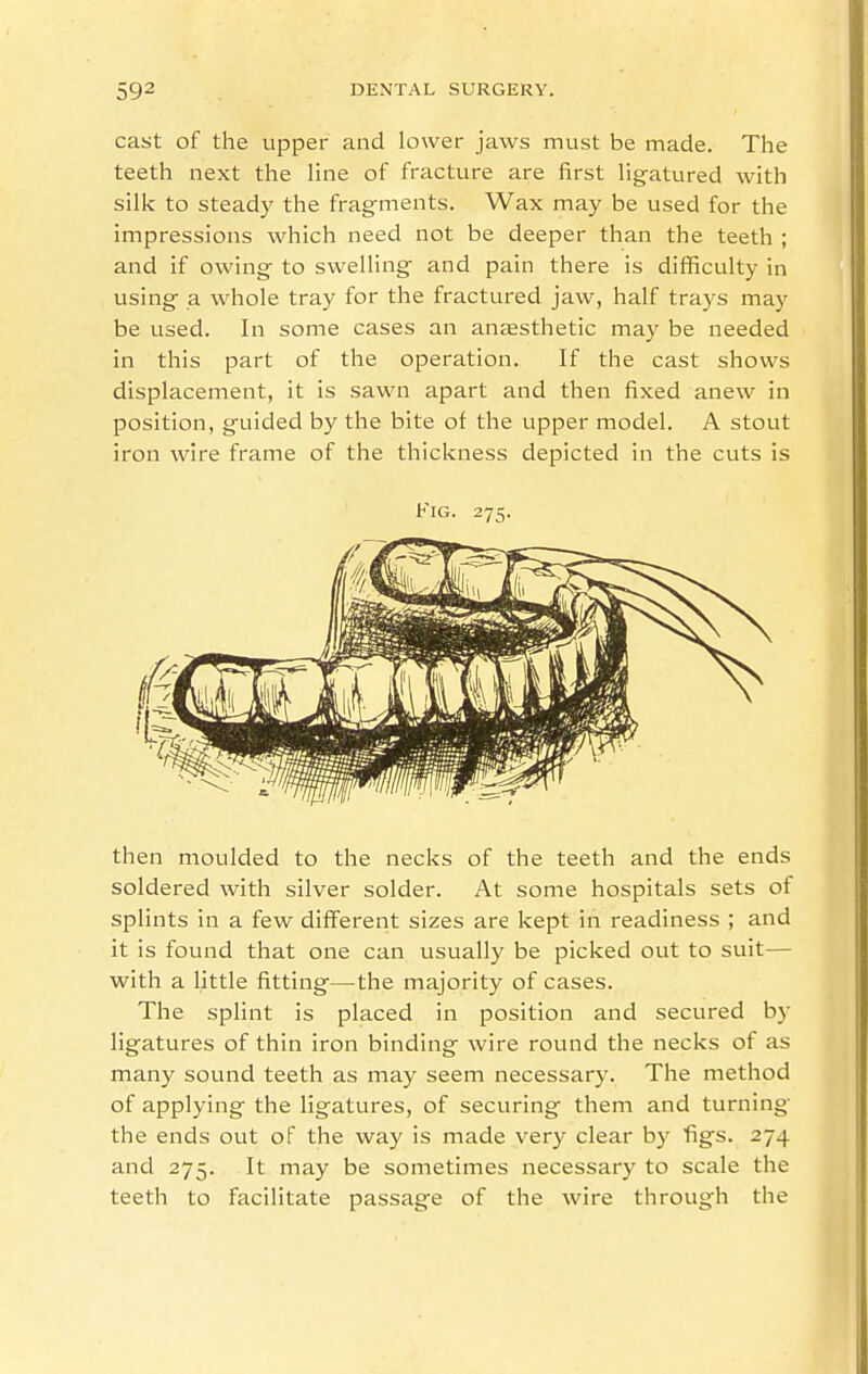 cast of the upper and lower jaws must be made. The teeth next the line of fracture are first ligatured with silk to steady the fragments. Wax may be used for the impressions which need not be deeper than the teeth ; and if owing to swelling and pain there is difficulty in using a whole tray for the fractured jaw, half trays may be used. In some cases an anaesthetic may be needed in this part of the operation. If the cast shows displacement, it is sawn apart and then fixed anew in position, guided by the bite of the upper model. A stout iron wire frame of the thickness depicted in the cuts is Fig. 275. then moulded to the necks of the teeth and the ends soldered with silver solder. At some hospitals sets of splints in a few different sizes are kept in readiness ; and it is found that one can usually be picked out to suit— with a little fitting—the majority of cases. The splint is placed in position and secured by ligatures of thin iron binding wire round the necks of as many sound teeth as may seem necessary. The method of applying the ligatures, of securing them and turning the ends out of the way is made very clear by figs. 274 and 275. It may be sometimes necessary to scale the teeth to facilitate passage of the wire through the