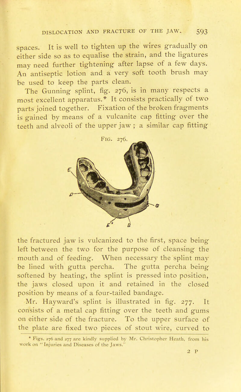 Spaces. It is well to tighten up the wires gradually on either side so as to equalise the strain, and the ligatures may need further tightening after lapse of a few days. An antiseptic lotion and a very soft tooth brush may be used to keep the parts clean. The Gunning splint, fig. 276, is in many respects a most excellent apparatus.* It consists practically of two parts joined together. Fixation of the broken fragments is gained by means of a vulcanite cap fitting over the teeth and alveoli of the upper jaw ; a similar cap fitting the fractured jaw is vulcanized to the first, space being left between the two for the purpose of cleansing the mouth and of feeding. When necessary the splint may be lined with gutta percha. The gutta percha being softened by heating, the splint is pressed into position, the jaws closed upon it and retained in the closed position by means of a four-tailed bandage. Mr. Hayward's splint is illustrated in fig. 277. It consists of a metal cap fitting over the teeth and gums on either side of the fracture. To the upper surface of the plate are fixed two pieces of stout wire, curved to * Figs. 276 and 277 are kindly supplied by Mr. Christopher Heath, from his work on  Injuries and Diseases of the J.iws. 2 P