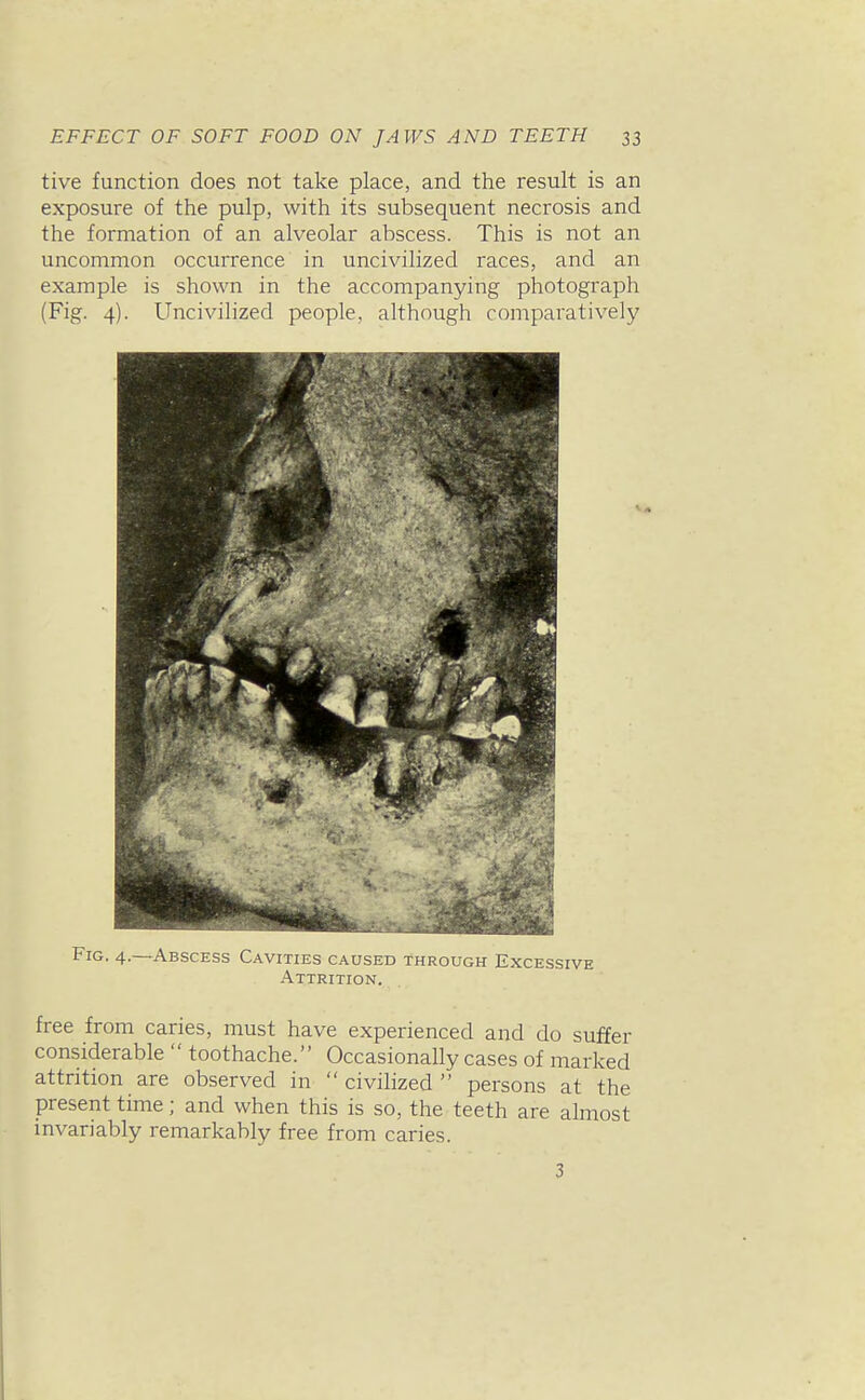 tive function does not take place, and the result is an exposure of the pulp, with its subsequent necrosis and the formation of an alveolar abscess. This is not an uncommon occurrence in uncivilized races, and an example is shown in the accompanying photograph (Fig. 4). Uncivilized people, although comparatively Fig. 4.—Abscess Cavities caused through Excessive Attrition. free from caries, must have experienced and do suffer considerable  toothache. Occasionally cases of marked attrition are observed in  civilized  persons at the present time; and when this is so, the teeth are almost invariably remarkably free from caries. 3