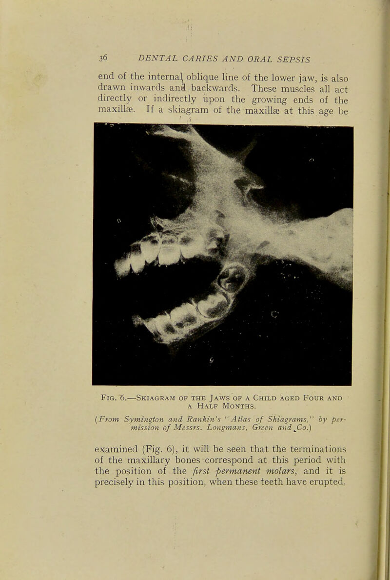 end of the internal oblique line of the lower jaw, is also drawn inwards and (backwards. These muscles all act directly or indirectly upon the growing ends of the maxillai. If a skiagram of the maxillae at this age be Fig. 6.—Skiagram of the Jaws of a Child aged Four and A Half Months. {From Symington and Rankin's Atlas of Skiagrams, by per- mission of Messrs. Longmans, Green and jOo.) examined (Fig. 6), it will be seen that the tei'minations of the maxiUary bones correspond at this period with the position of the first permanent molars, and it is precisely in this position, when these teeth have erupted.