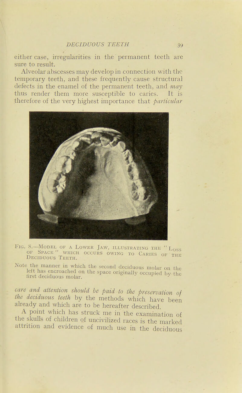 DECIDUOUS TEETH either case, irregularities in the permanent teeth are sure to result. Alveolar abscesses may develop in connection with tlie temporary teeth, and these frequently cause structural defects in the enamel of the pemianent teeth, and may thus render them more susceptible to caries. It is therefore of the very highest importance that parliciUar I'lG. S. ^ftlODEL OK A LoWER JavV, ILLUSTRATING THE  J Note the manner in which the secoml deciduous molar on the left has encroached on the .space originallv occupied by the lirst deciduous molar.  y care and attention shotild be paid to the preservation of the decidtiotis teeth by the methods which have been already and which are to be hereafter described. A point which has struck me in the examination of the skuUs of children of uncivilized races is the marked attrition and evidence of much use in the deciduous