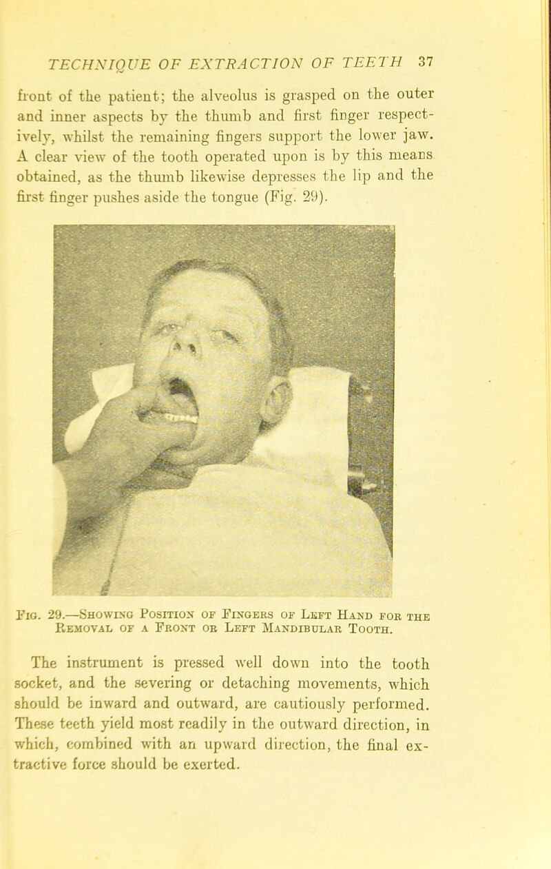 front of the patient; the alveolus is grasped on the outer and inner aspects by the thumb and first finger respect- ively, whilst the remaining fingers support the lower jaw. A clear view of the tooth operated upon is by this means obtained, as the thumb likewise depresses the lip and the first finger pushes aside the tongue (Fig. 29). Fio. 29.—Showing Position of Fingers of Left Hand foe the REMOVAL OF A FRONT OE LEFT MaNDIBULAE TOOTH. The instrument is pressed well down into the tooth socket, and the severing or detaching movements, which should be inward and outward, are cautiously performed. These teeth yield most readily in the outward direction, in which, combined with an upward direction, the final ex- tractive force should be exerted.