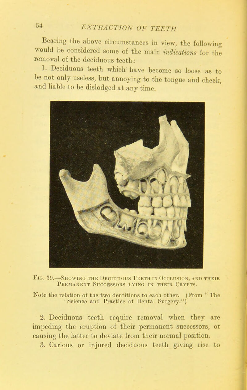 Bearing the above circumstances in view, the following would be considered some of the main indications for the removal of the deciduous teeth : 1. Deciduous teeth which have become so loose as to be not only useless, but annoying to the tongue and cheek, and liable to be dislodged at any time. Pig. 39.—Showing the Deciduous Teeth in Occlusion, and theik Permanent Successors lying in their Crytts. Note the relation of the two dentitions to each other. (Prom  The Science and Practice of Dental Surgery.) 2. Deciduous teeth require removal when they are impeding the eruption of their permanent successors, or causing the latter to deviate from their normal position. 3. Carious or injured deciduous teeth giving rise to