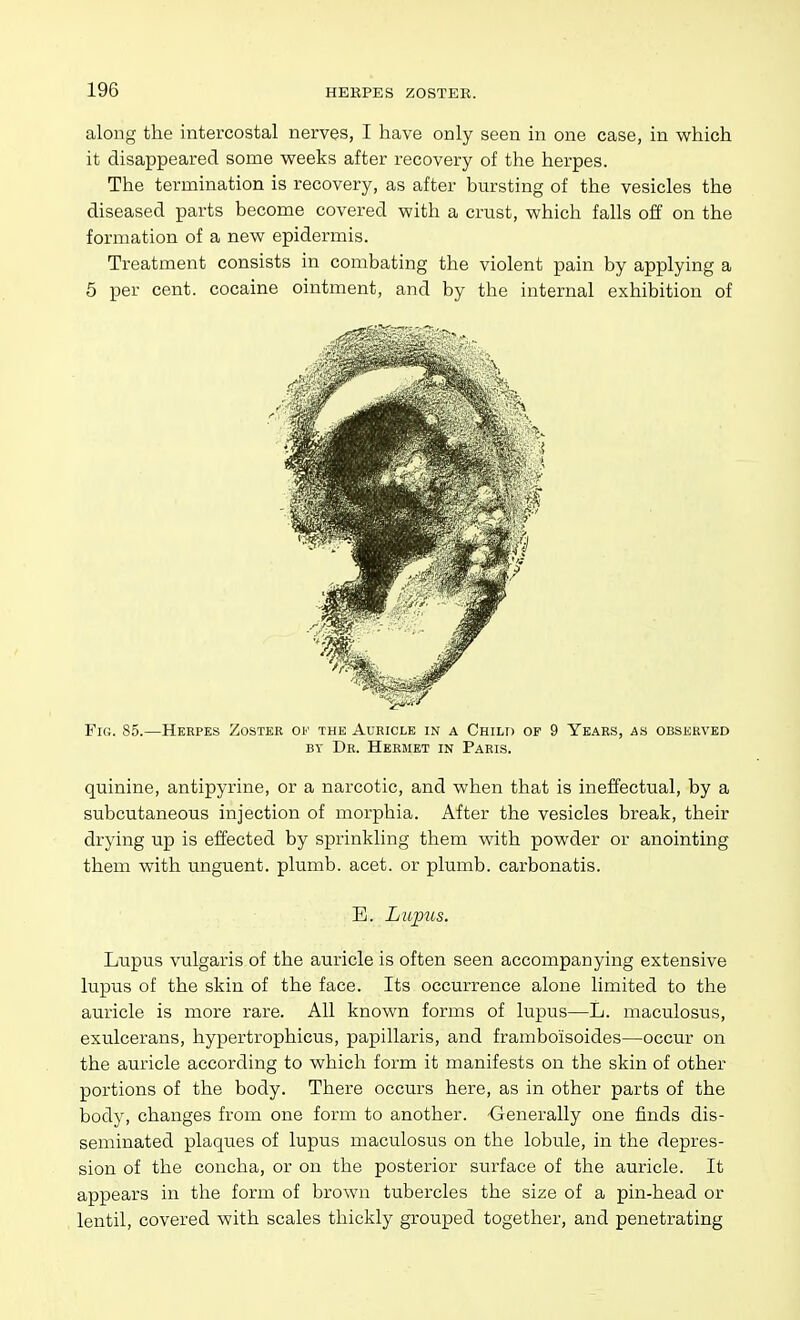 along the intercostal nerves, I have only seen in one case, in which it disappeared some weeks after recovery of the herpes. The termination is recovery, as after bursting of the vesicles the diseased parts become covered with a crust, which falls off on the formation of a new epidermis. Treatment consists in combating the violent pain by applying a 5 per cent, cocaine ointment, and by the internal exhibition of Fig. 85.—Herpes Zoster of the Auricle in a Child op 9 Years, as observed BY Dr. Hermet in Paris. quinine, antipyrine, or a narcotic, and when that is ineffectual, by a subcutaneous injection of morphia. After the vesicles break, their drying up is effected by sprinkling them with powder or anointing them with unguent, plumb, acet. or plumb, carbonatis. E. Lupus. Lupus vulgaris of the auricle is often seen accompanying extensive lupus of the skin of the face. Its occurrence alone limited to the auricle is more rare. All known forms of lupus—L. maculosus, exulcerans, hypertrophicus, papillaris, and frambo'isoides—occur on the auricle according to which form it manifests on the skin of other portions of the body. There occurs here, as in other parts of the body, changes from one form to another. Generally one finds dis- seminated plaques of lupus maculosus on the lobule, in the depres- sion of the concha, or on the posterior surface of the auricle. It appears in the form of brown tubercles the size of a pin-head or lentil, covered with scales thickly grouped together, and penetrating