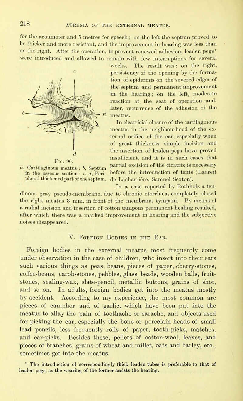 for the acoumeter and 5 metres for speech ; on the left the septum proved to be thicker and more resistant, and the improvement in hearing was less than on the right. After the operation, to prevent renewed adhesion, leaden pegs* were introduced and allowed to remain with few interruptions for several weeks. The result was: on the right, persistency of the opening by the forma- tion of epidermis on the severed edges of the septimi and permanent improvement in the hearmg; on the left, moderate reaction at the seat of operation and, later, recurrence of the adhesion of the meatus. In cicatricial closure of the cartilaginous meatus in the neighbourhood of the ex- ternal orifice of the ear, especially when of great thickness, simple incision and the insertion of leaden pegs have proved insufficient, and it is in such cases that partial excision of the cicatrix is necessary in the osseous section '; c, fZ, Peri- before the introduction of tents (Ladreit pheral thickened part of the septum, de Lacharriere, Samuel Sexton). In a case reported by Rothholz a ten- dinous gray pseudo-membrane, due to clironic otorrhcea, completely closed the right meatus 3 mm. in front of the membrana tympani. By means of a radial incision and insertion of cotton tampons permanent healing resulted, after which there was a marked improvement in hearing and the subjective noises disappeared. V. Foreign Bodies in the Ear. Foreign bodies in the external meatus most frequently come under observation in the case of children, who insert into their ears such various things as peas, beans, pieces of paper, cherry-stones, coffee-beans, carob-stones, pebbles, glass beads, wooden balls, fruit- stones, sealing-wax, slate-pencil, metallic buttons, grains of shot, and so on. In adults, foreign bodies get into the meatus mostly by accident. According to my experience, the most common are pieces of camphor and of garlic, which have been put into the meatus to allay the pain of toothache or earache, and objects used for picking the ear, especially the bone or porcelain heads of small lead pencils, less frequently rolls of paper, tooth-picks, matches, and ear-picks. Besides these, pellets of cotton-wool, leaves, and pieces of branches, grains of wheat and millet, oats and barley, etc., sometimes get into the meatus. * The introduction of correspondingly thick leaden tubes is preferable to that of leaden pegs, as the wearing of the former assists the hearing. c d Fk;. 90. a, Cartilaerinous meatus : h. Seotum