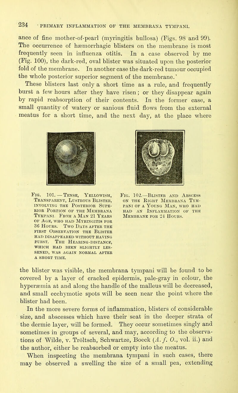 ance of fine mother-of-pearl (myringitis bullosa) (Figs. 98 and 99). The occurrence of hfemorrhagic blisters on the membrane is most frequently seen in influenza otitis. In a case observed by me (Fig. 100), the dark-red, oval blister was situated upon the posterior fold of the membrane. In another case the dark-red tumour occupied the whole posterior superior segment of the membrane.' These blisters last only a short time as a rule, and frequently burst a few hours after they have risen; or they disappear again by rapid reabsorption of their contents. In the former case, a small quantity of watery or sanious fluid flows from the external meatus for a short time, and the next day, at the place where Fig. 101.—Tense, Yellowish, Thansparent, Lustrous Blister, involving the posterior supe- RIOR Portion of the Membrana Tympani. From a Man 21 Years of Age, who had Myringitis for 36 Hours. Two Days after the first Observation the Blister had disapl'eared without having BURST. The Hearing-distance, WHICH had been slightly LES- SENED, WAS again normal AFTER A SHORT TIME. Fig. 102.—Blister and Abscess ON THE Right Membhana Tym- pani of a Young Man, who had had an Inflammation of the Membrane for 24 Hours. the blister was visible, the membrana tympani will be found to be covered by a layer of cracked epidermis, pale-gray in colour, the hypergemia at and along the handle of the malleus will be decreased, and small ecchymotic spots will be seen near the point where the blister had been. In the more severe forms of inflammation, blisters of considerable size, and abscesses which have their seat in the deeper strata of the dermic layer, will be formed. They occur sometimes singly and sometimes in groups of several, and may, according to the observa- tions of Wilde, V. Troltsch, Schwartze, Boeck {A. f. 0., vol. ii.) and the author, either be reabsorbed or empty into the meatus. When inspecting the membrana tympani in such cases, there may be observed a swelling the size of a small pea, extending